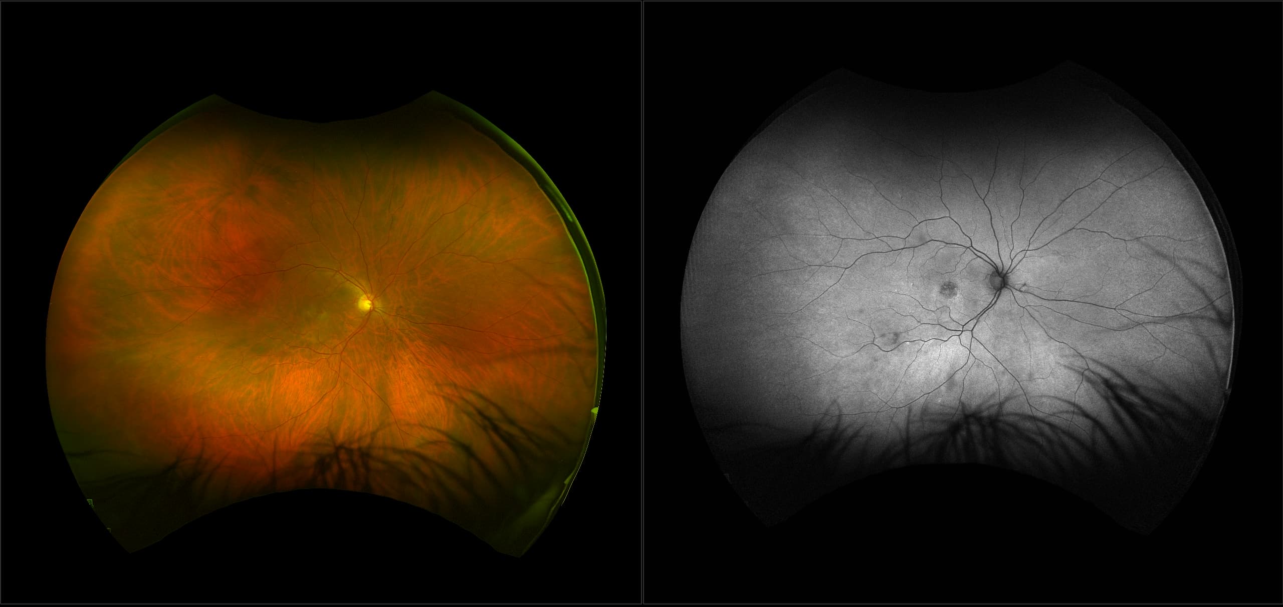 California - Viteliform Macular Dystrophy, RG, AF