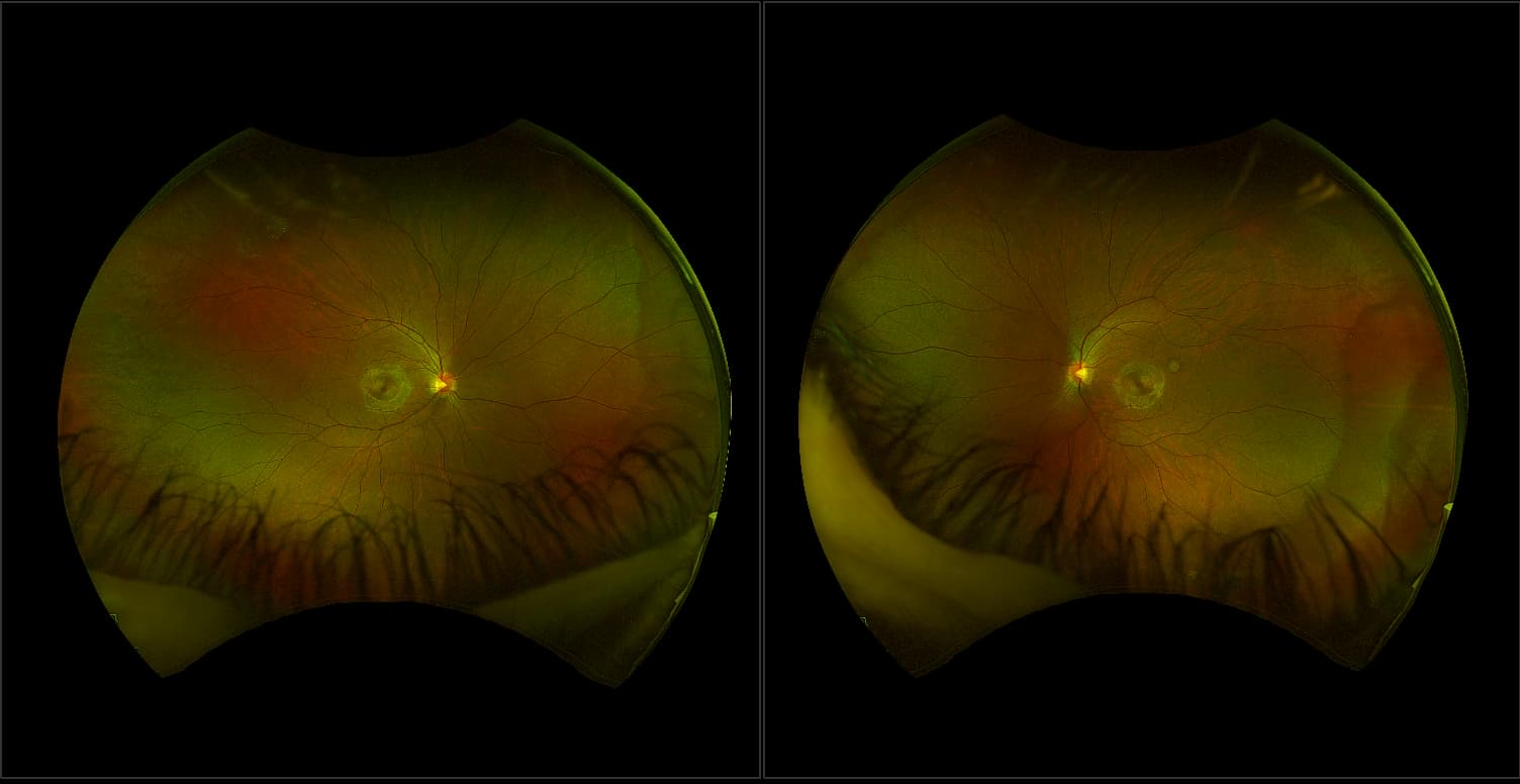 California - Lattice Degeneration, RG