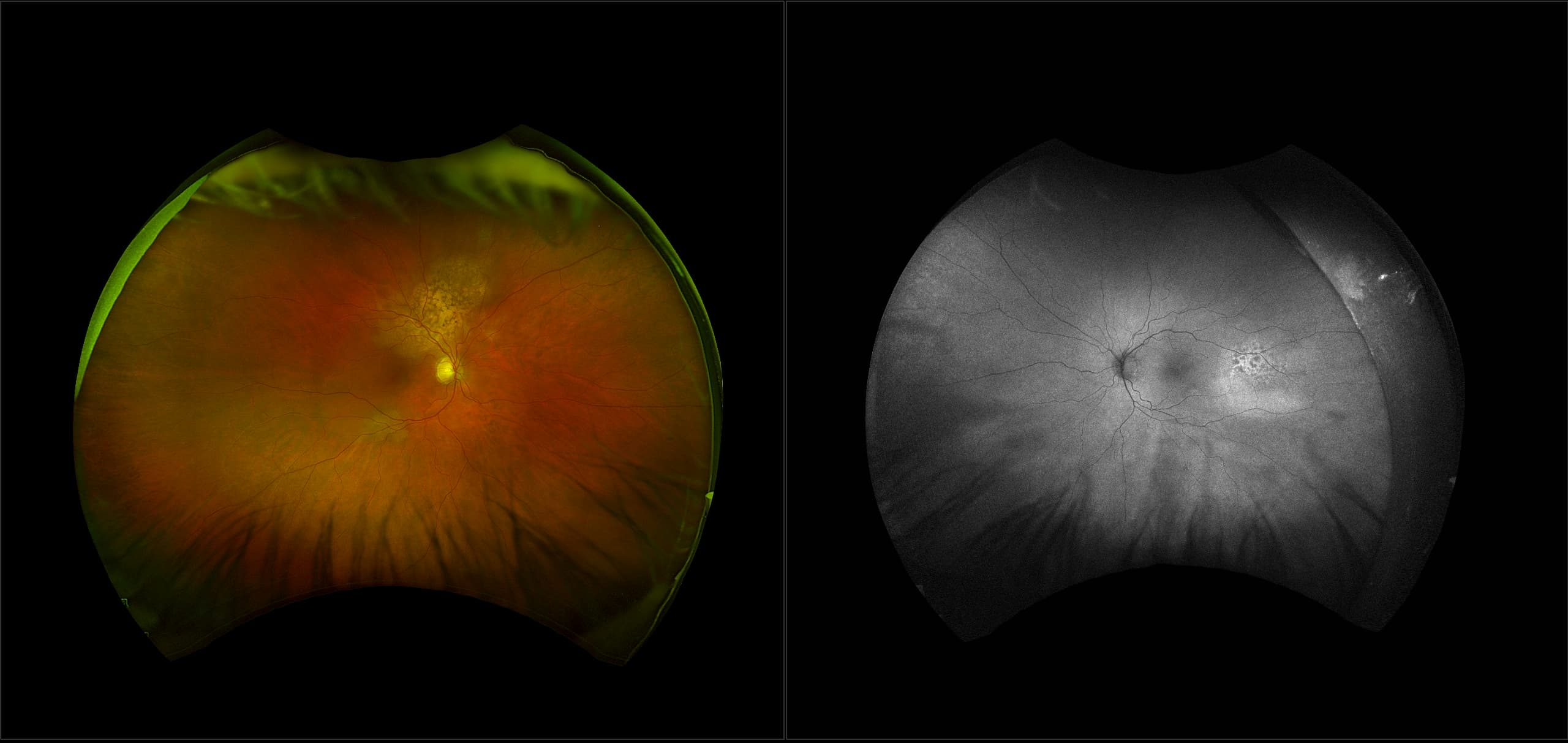 California - Choroidal Metastasis, RG, AF