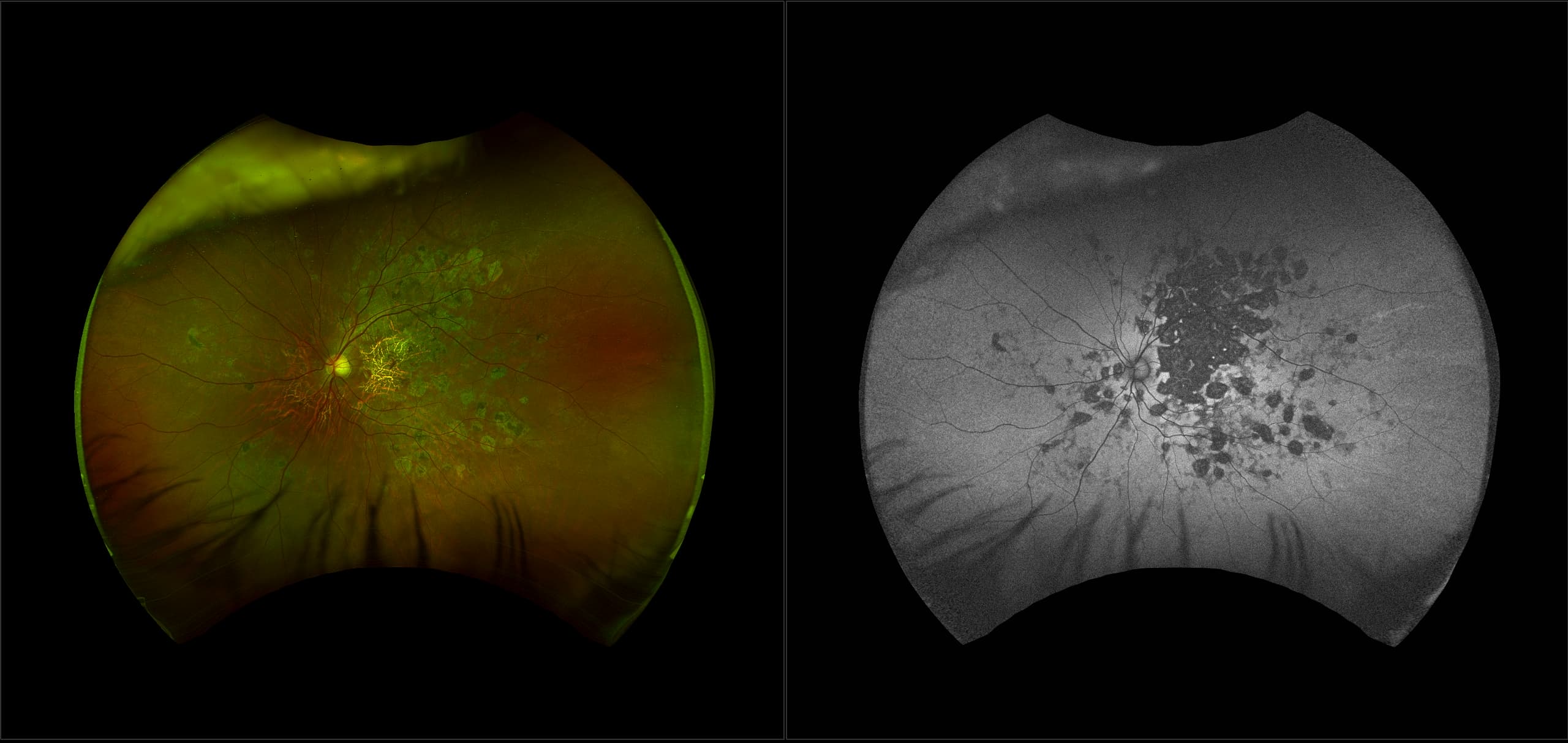 California - Tuberculous Serpiginoid Chorioretinopathy, RG, AF