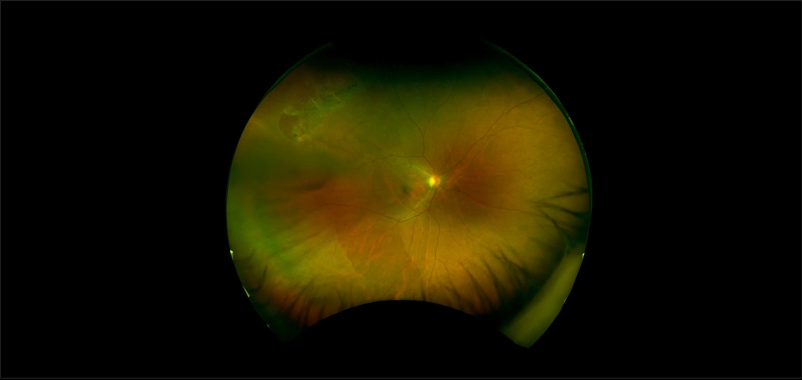 California - Peripheral Retinal Tear, RG