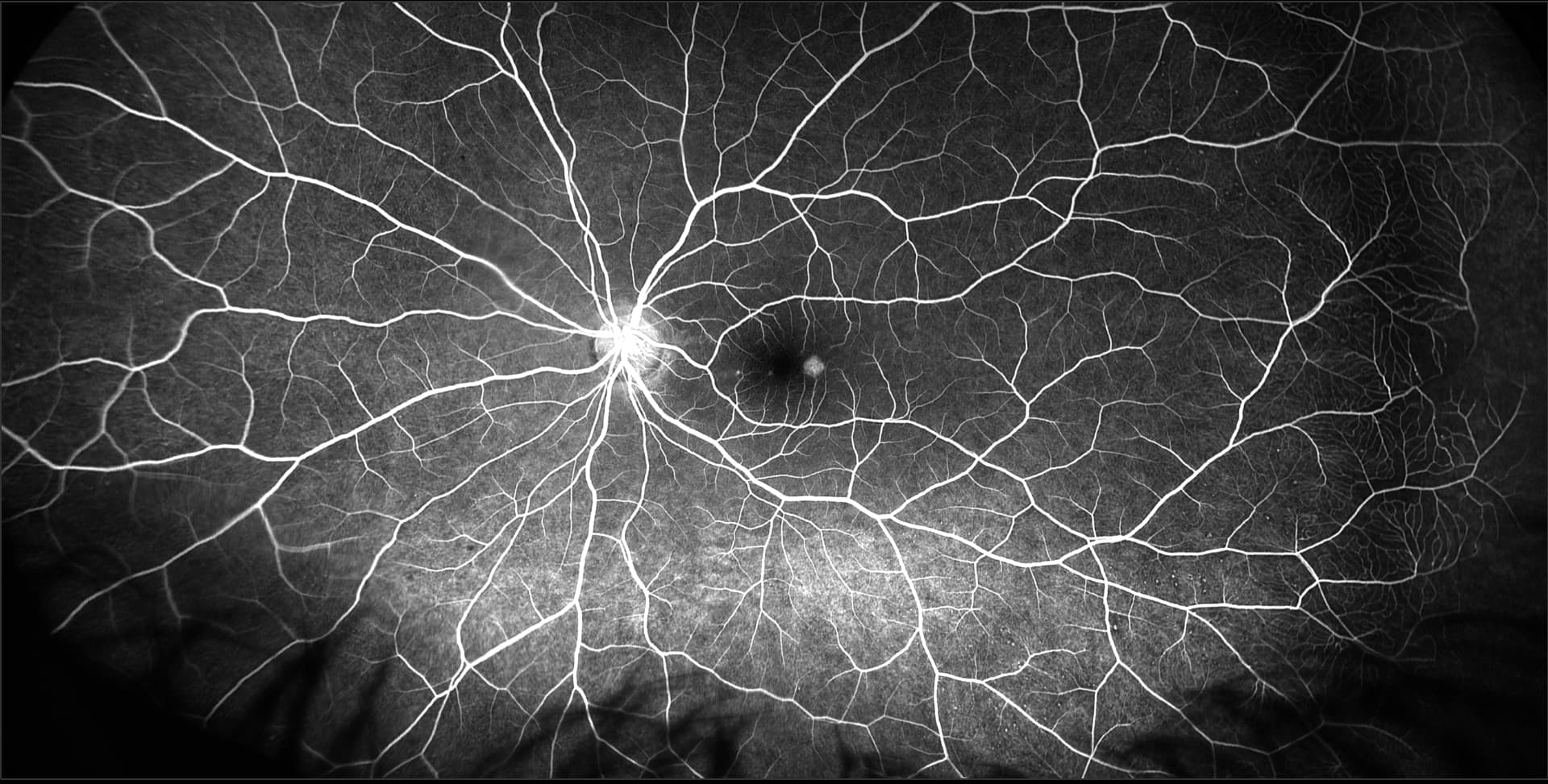 California - Central Serous Chorioretinopathy, FA