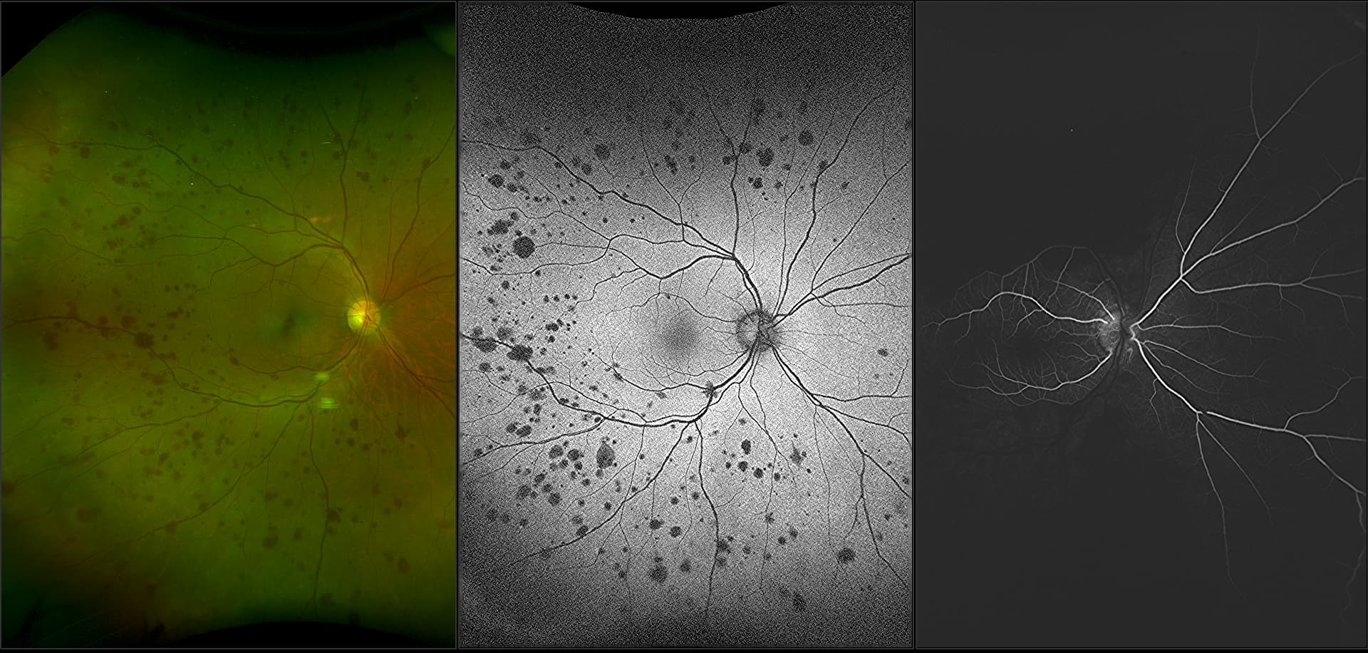 California - Ocular Ischemic Syndrome, RG, AF, FA