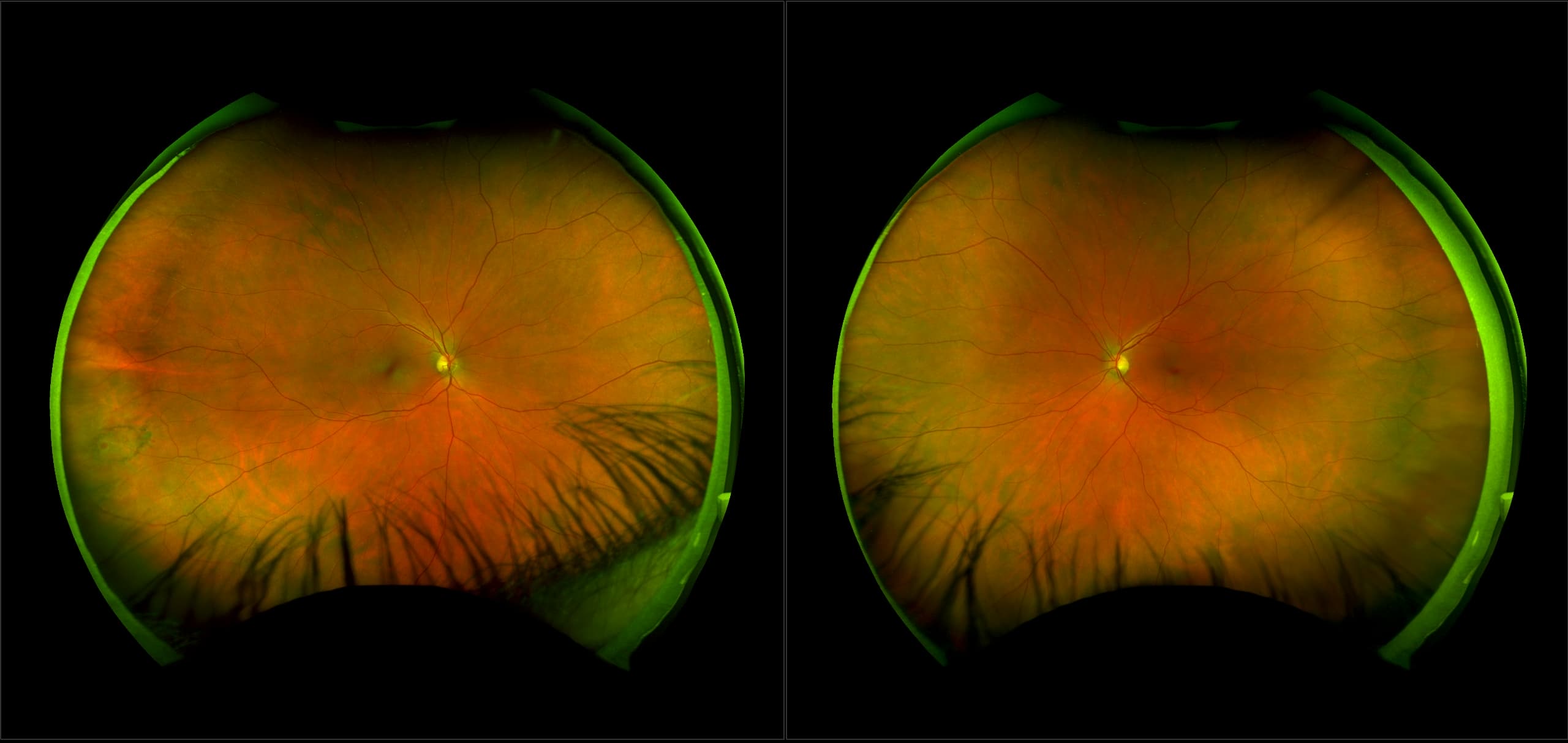 California - Retinal Hole, RG