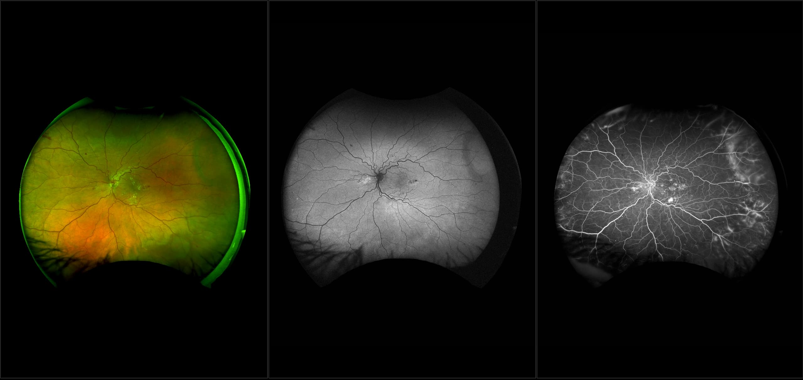 California - Severe Non-Proliferative Diabetic Retinopathy, RG, AF, FA