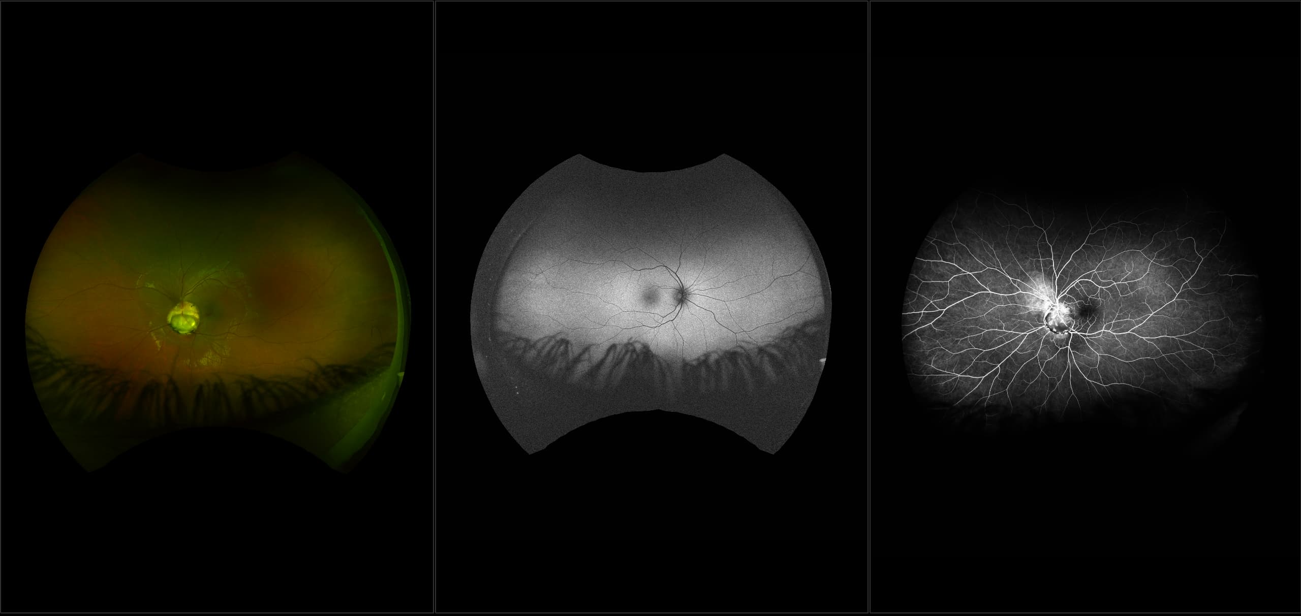 California - Morning Glory Syndrome, RG, AF, FA