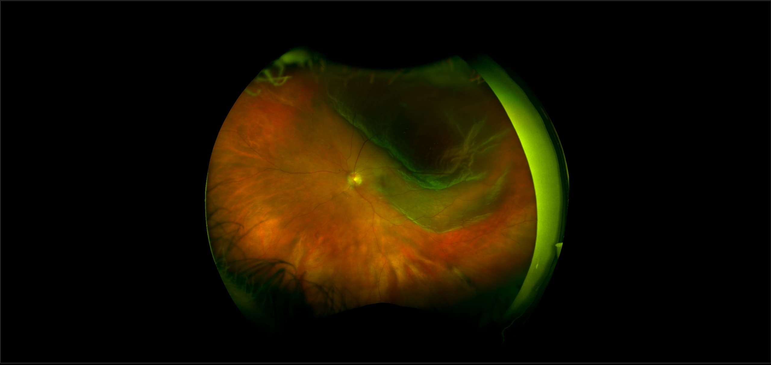 California - Retinal Detachment, RG