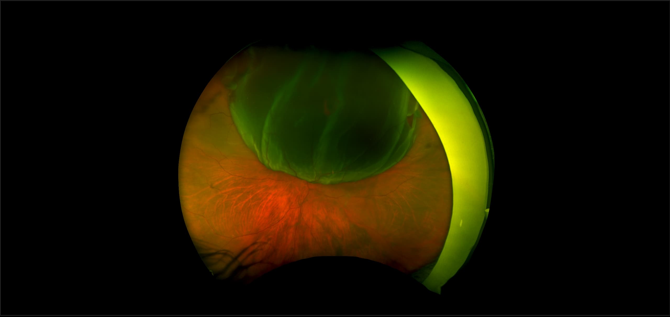 California - Retinal Detachment, RG