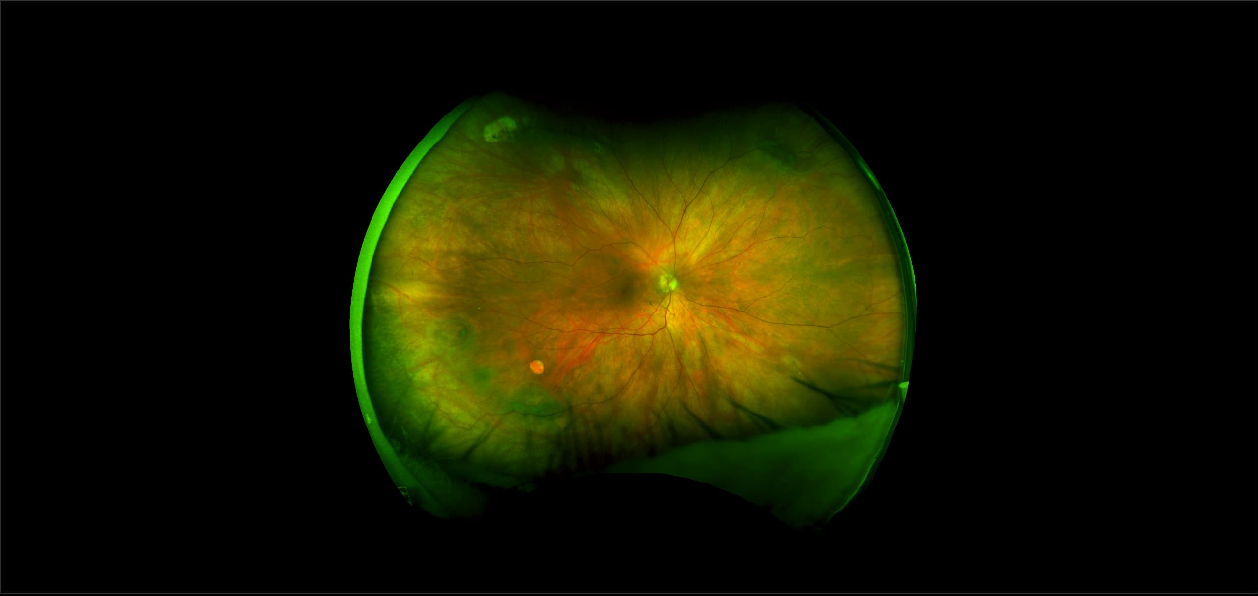 California - Retinal Hole, RG