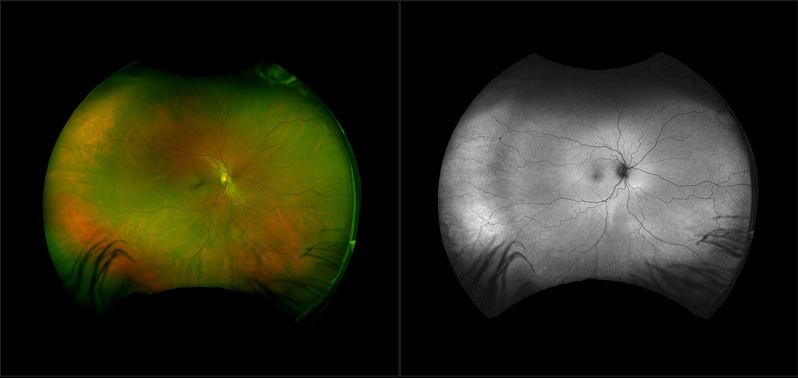 California - Melanoma with Brachytherapy, RG, AF