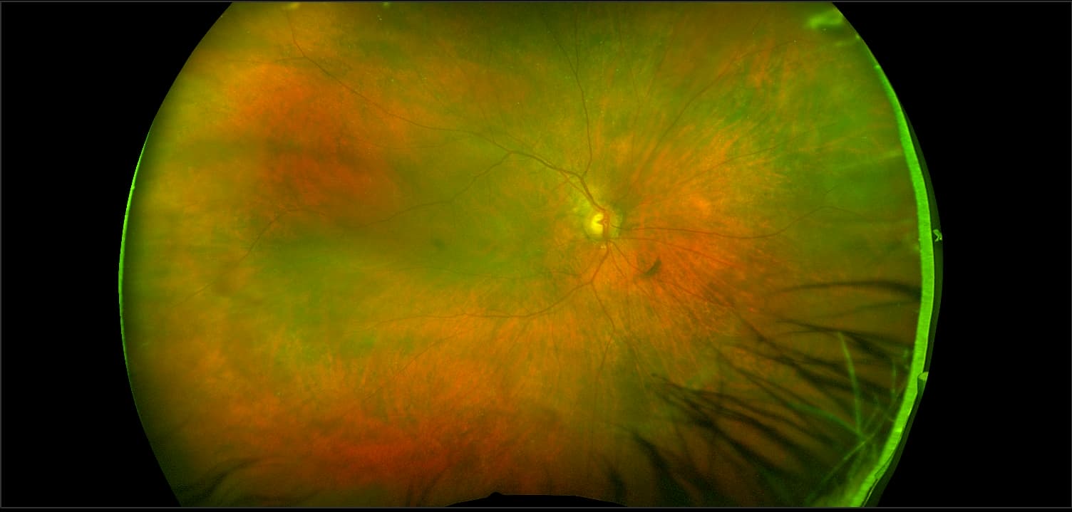 California - Branch Retinal Vein Occlusion (BRVO), RG