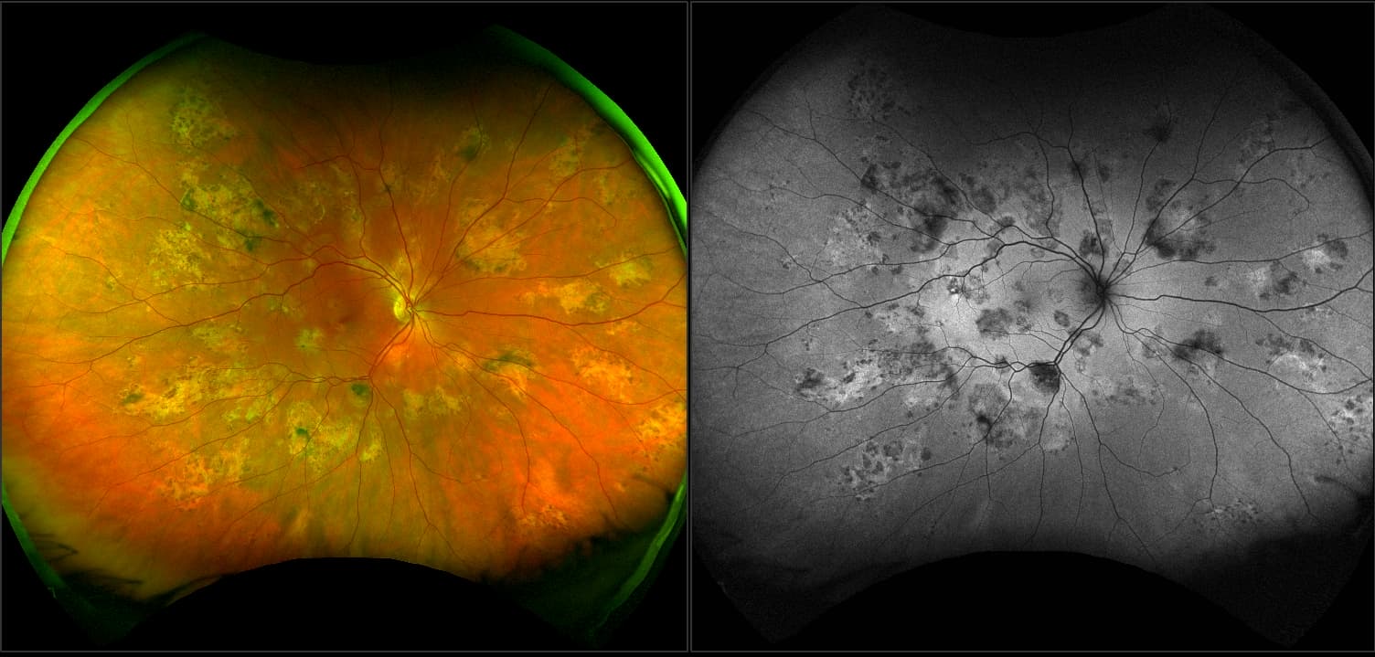 California - Acute Multifocal Placoid Pigment Epitheliopathy (AMPPE), RG, AF