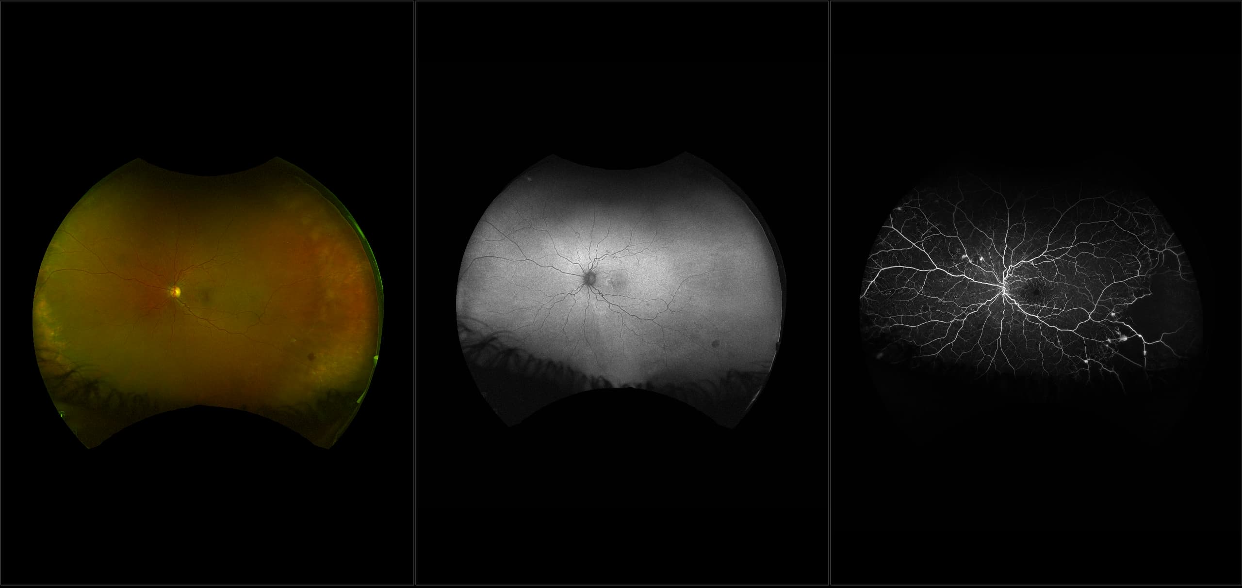 California - NPDR with Macular Edema, RG, AF, FA