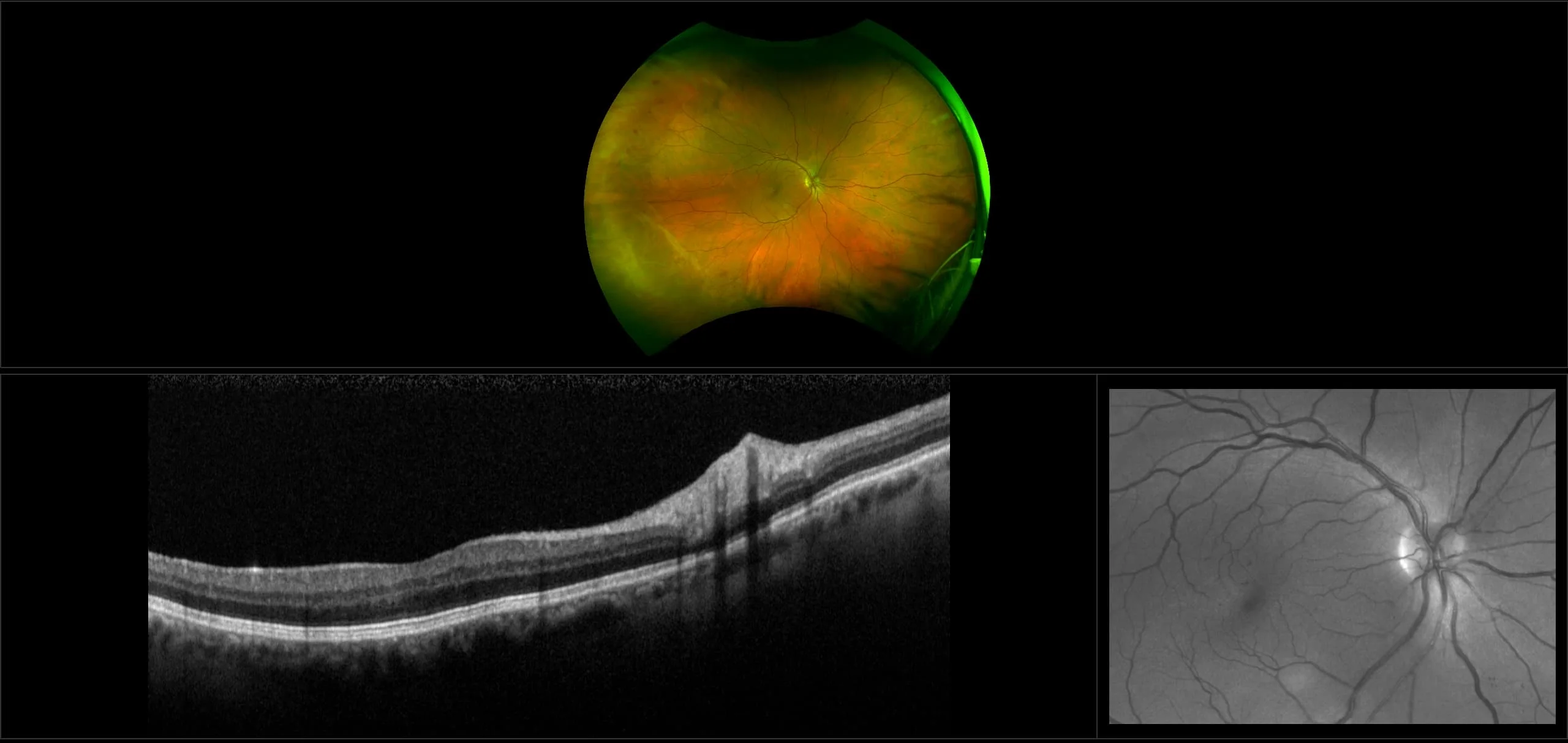 MonacoPro - Non-Proliferative Diabetic Retinopathy with PPL, RG, OCT