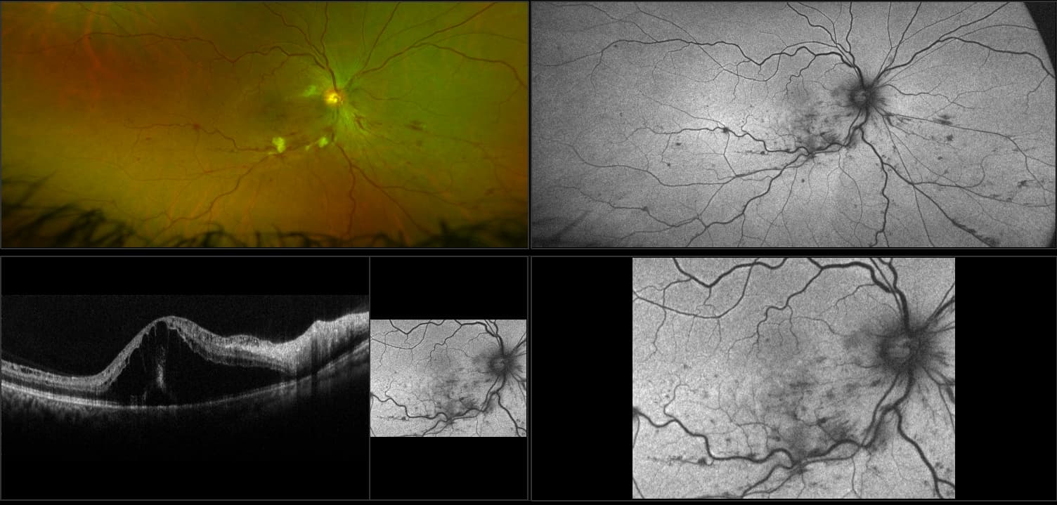 Monaco - Hemi Retinal Vein Occlusion, RG, AF, OCT