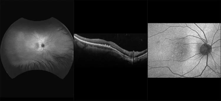 MonacoPro - Early AMD with Drusen, RG, AF, OCT
