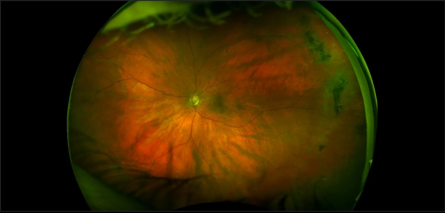 MonacoPro - Lattice Degeneration with Glaucoma, RG