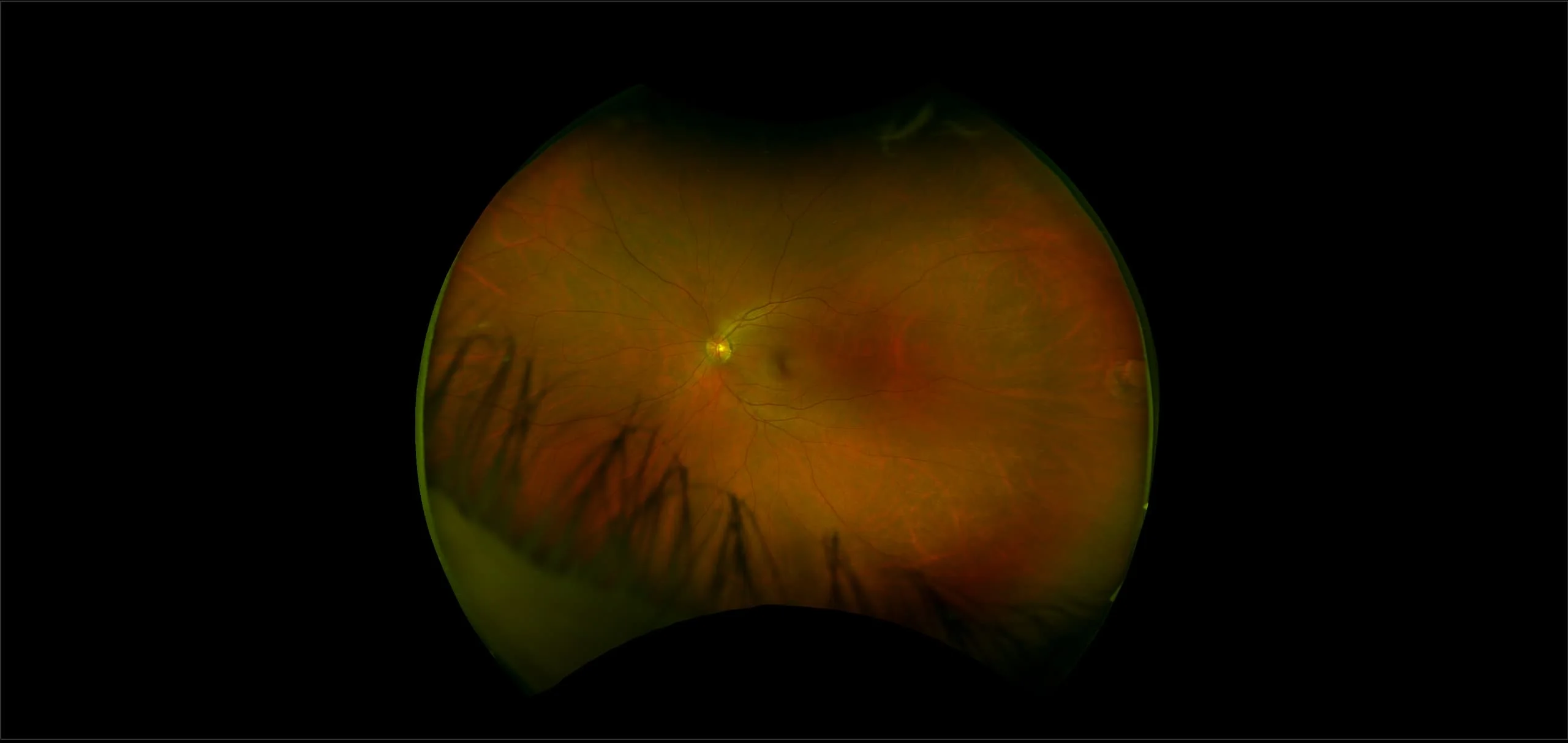MonacoPro - Peripheral Atrophy, RG
