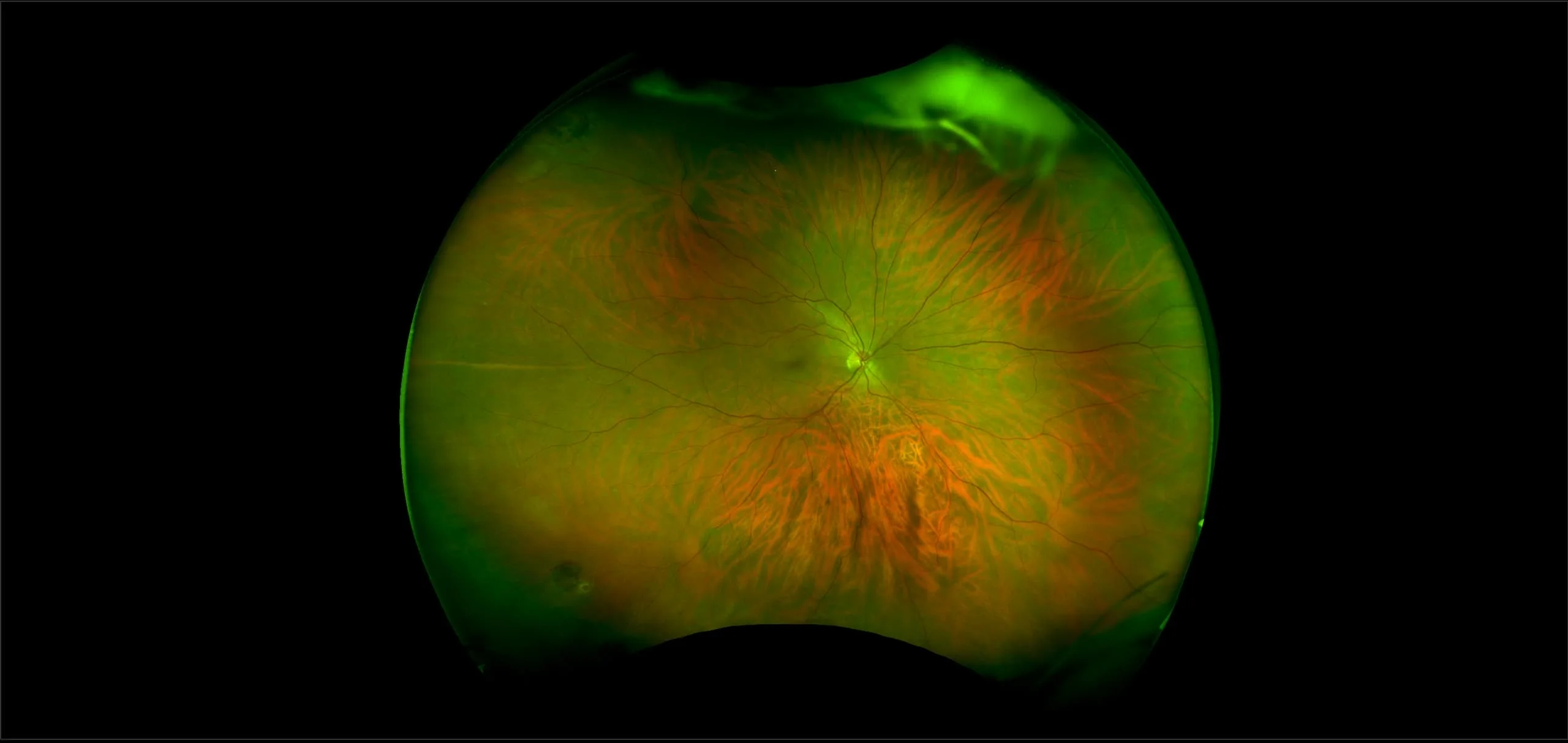 MonacoPro - Retinal Hole, RG