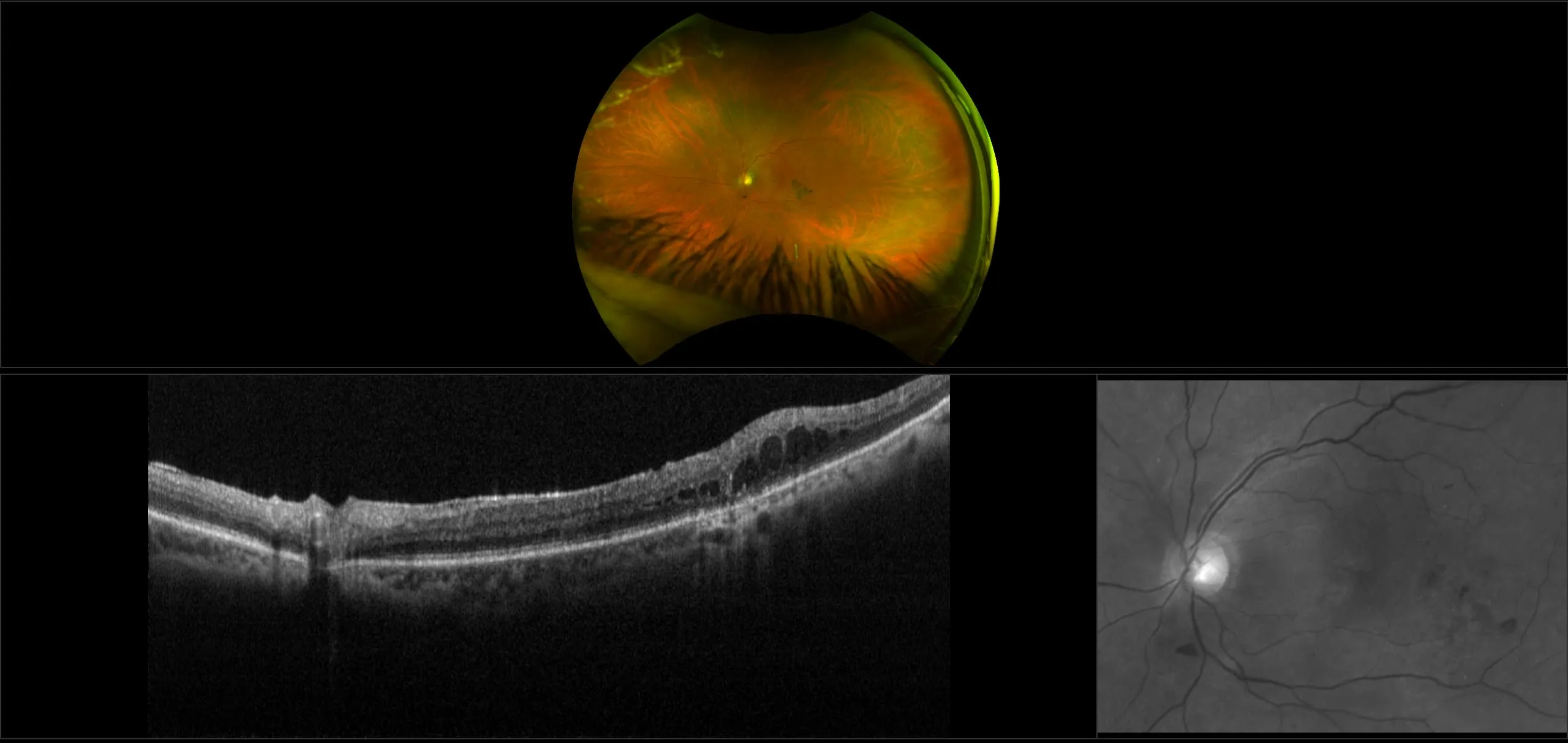 MonacoPro - Diabetic Macular Edema with Ozurex Implant, RG, OCT