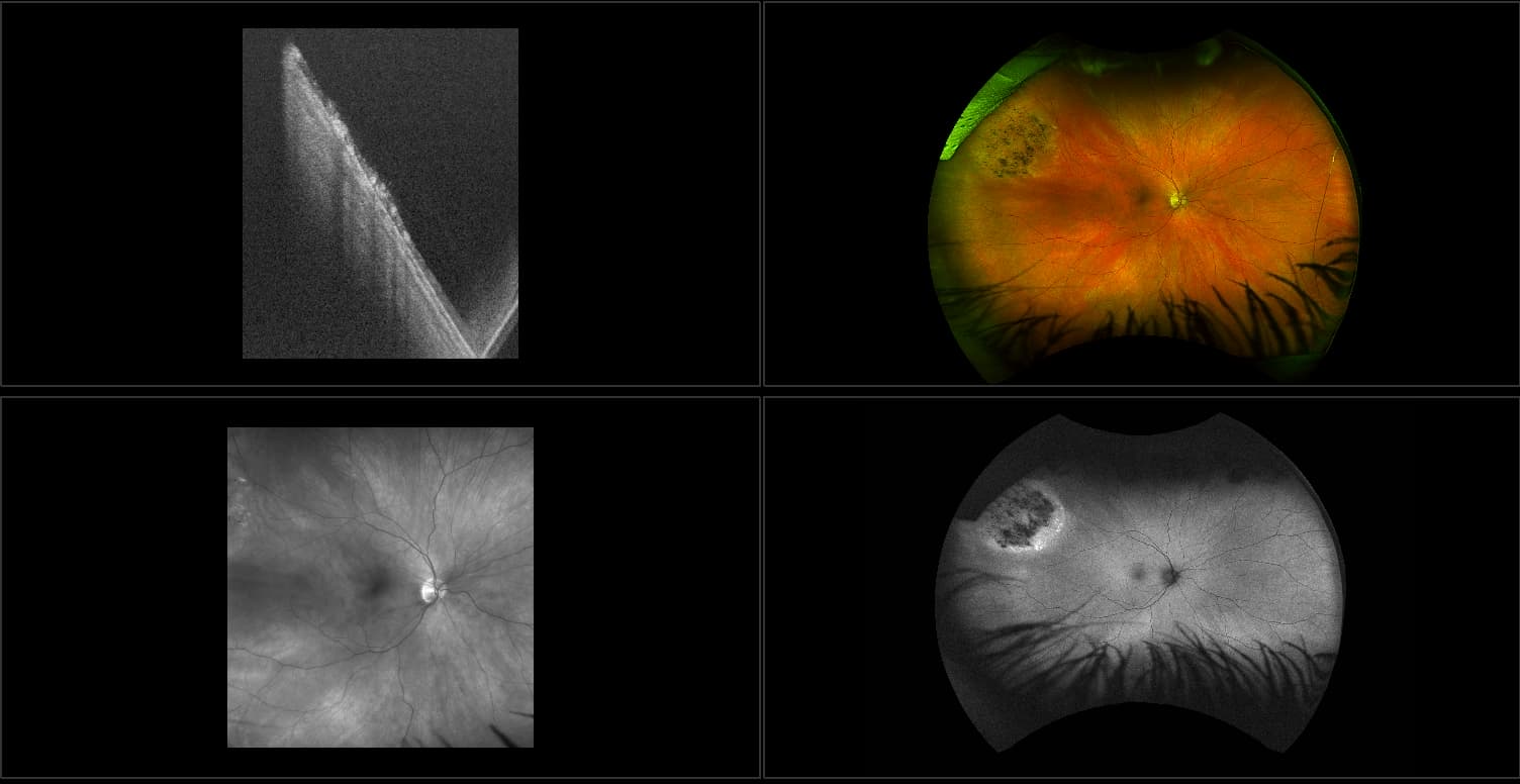 Silverstone - Uveal Melanoma with Chorioretinal Scars, RG, AF, OCT