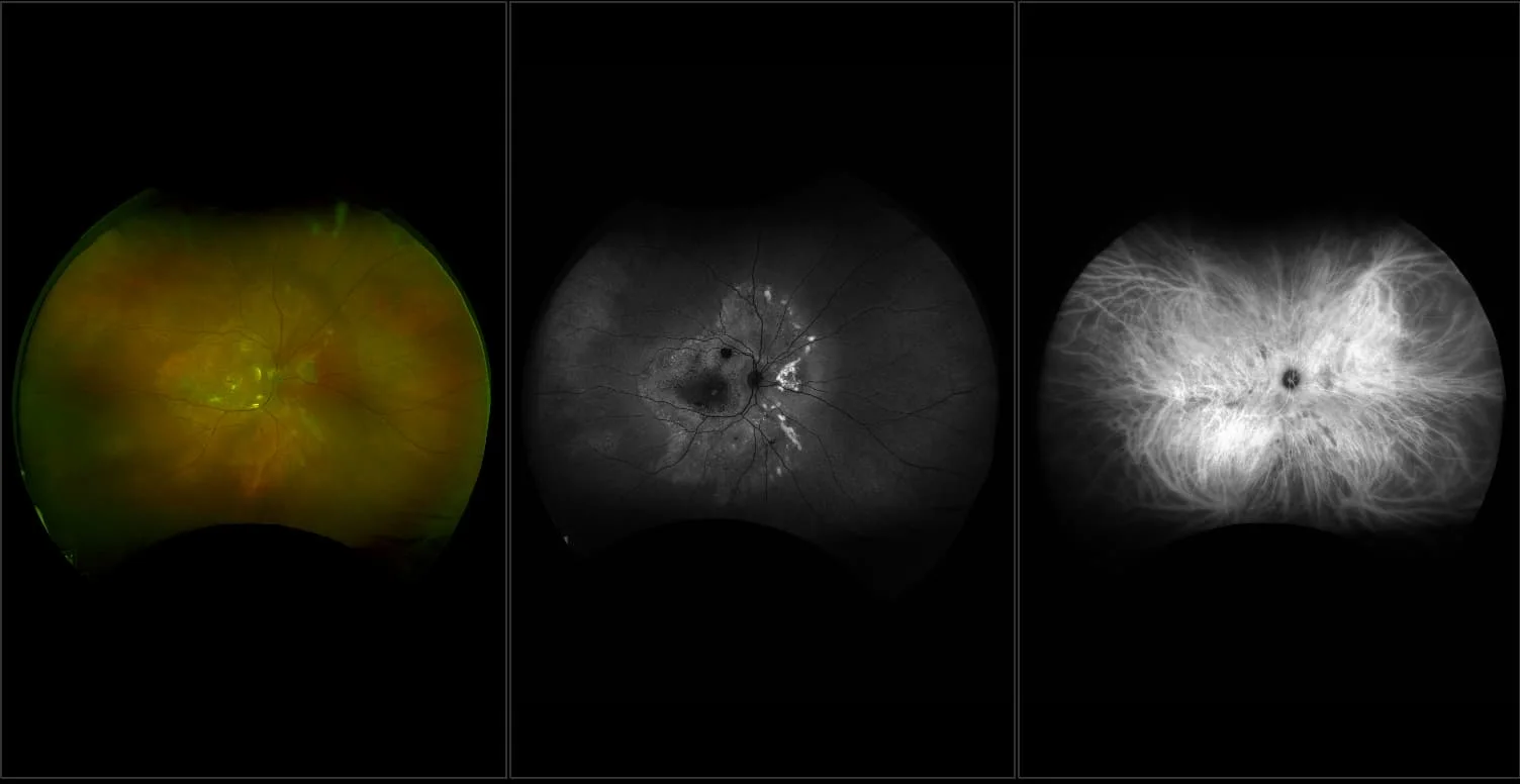 Silverstone - Best's Disease with Hereditary Retinal Dystrophy, RG, AF, ICG