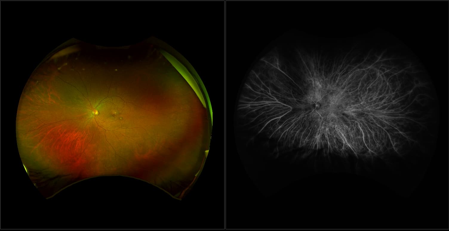 Silverstone - Branch Retinal Vein Occlusion (BRVO) with Macular Edema, RG, ICG