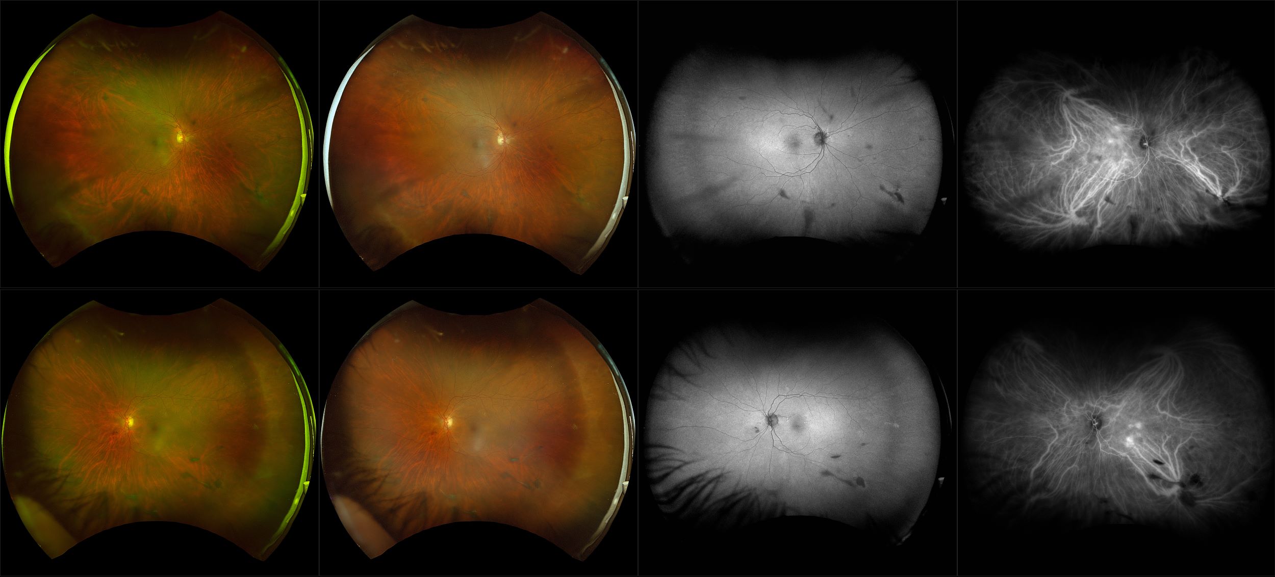 California - Diabetic Retinopathy, RG, RGB, AF, ICG