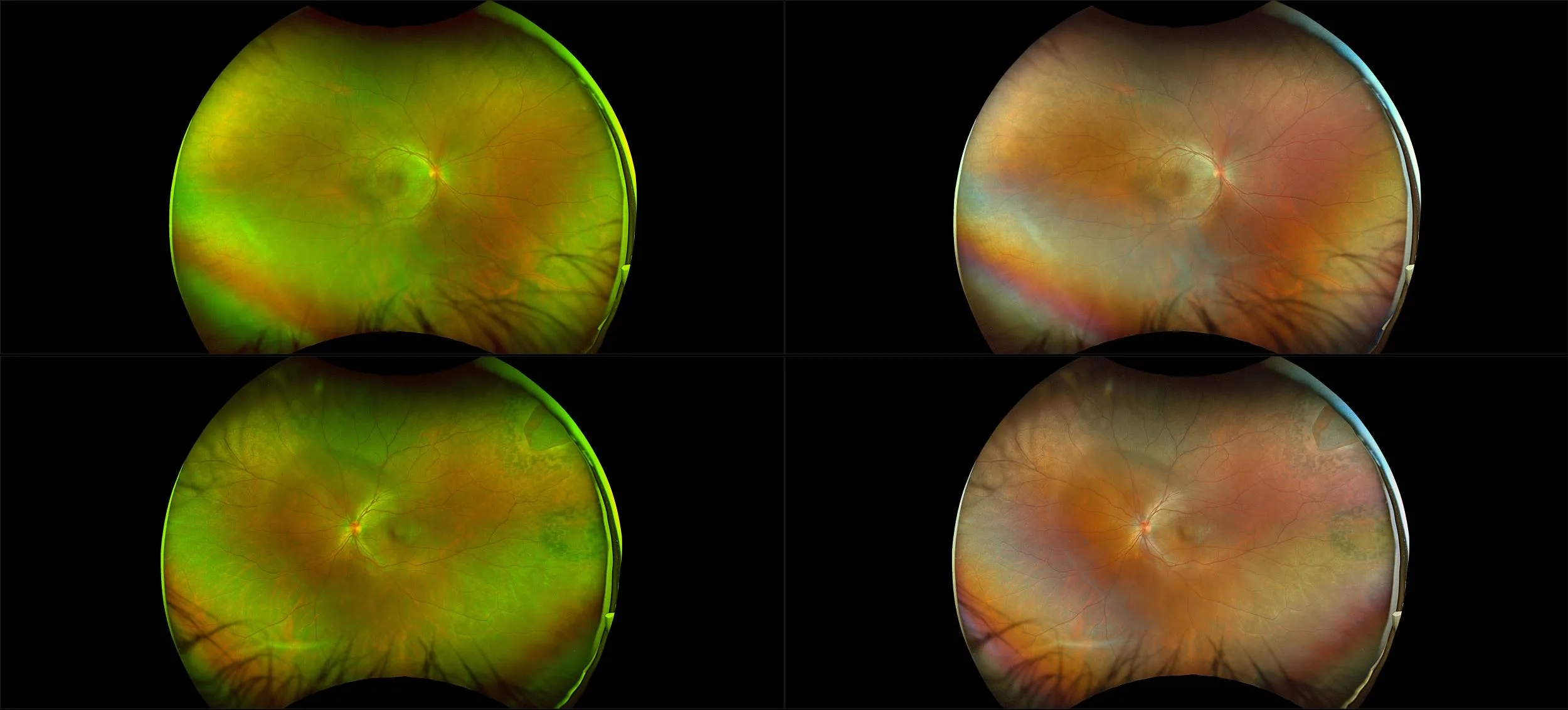 California - Retinal Tear with Posterior Uveitis, RG, RGB
