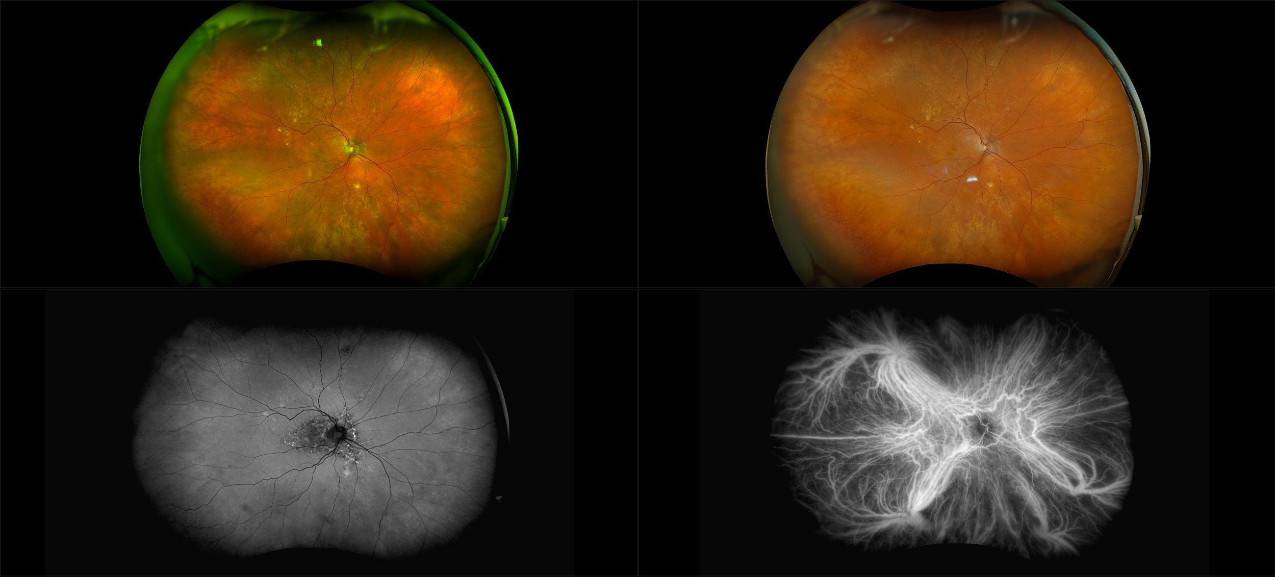 California - Peripapillary Pachychoroid Syndrome, RG, RGB, AF, ICG