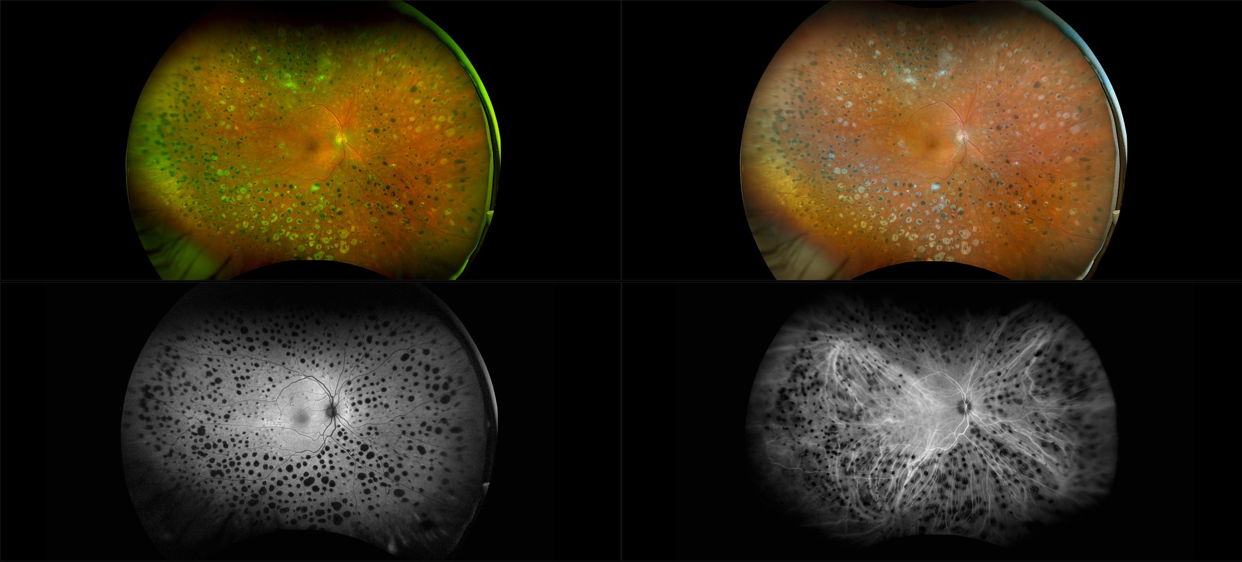 California - Diabetic Retinopathy, RG, RGB, AF, ICG