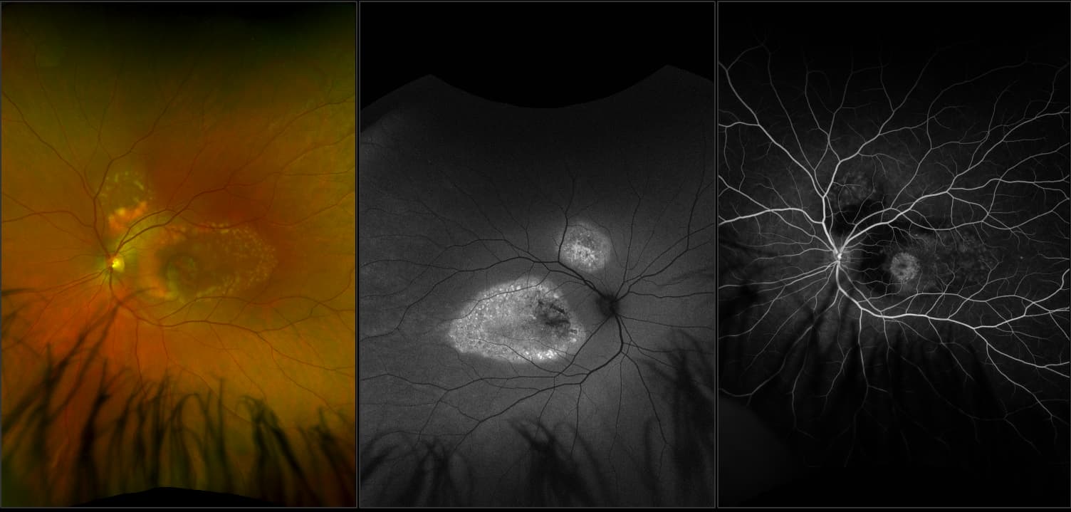 California - Best's Disease, RG, AF, FA