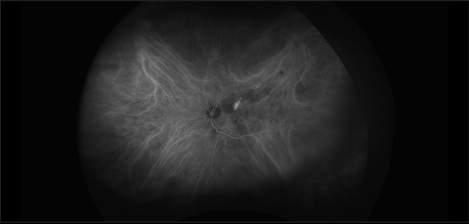 California - Polypoidal Choroidal Vasculopathy, ICG