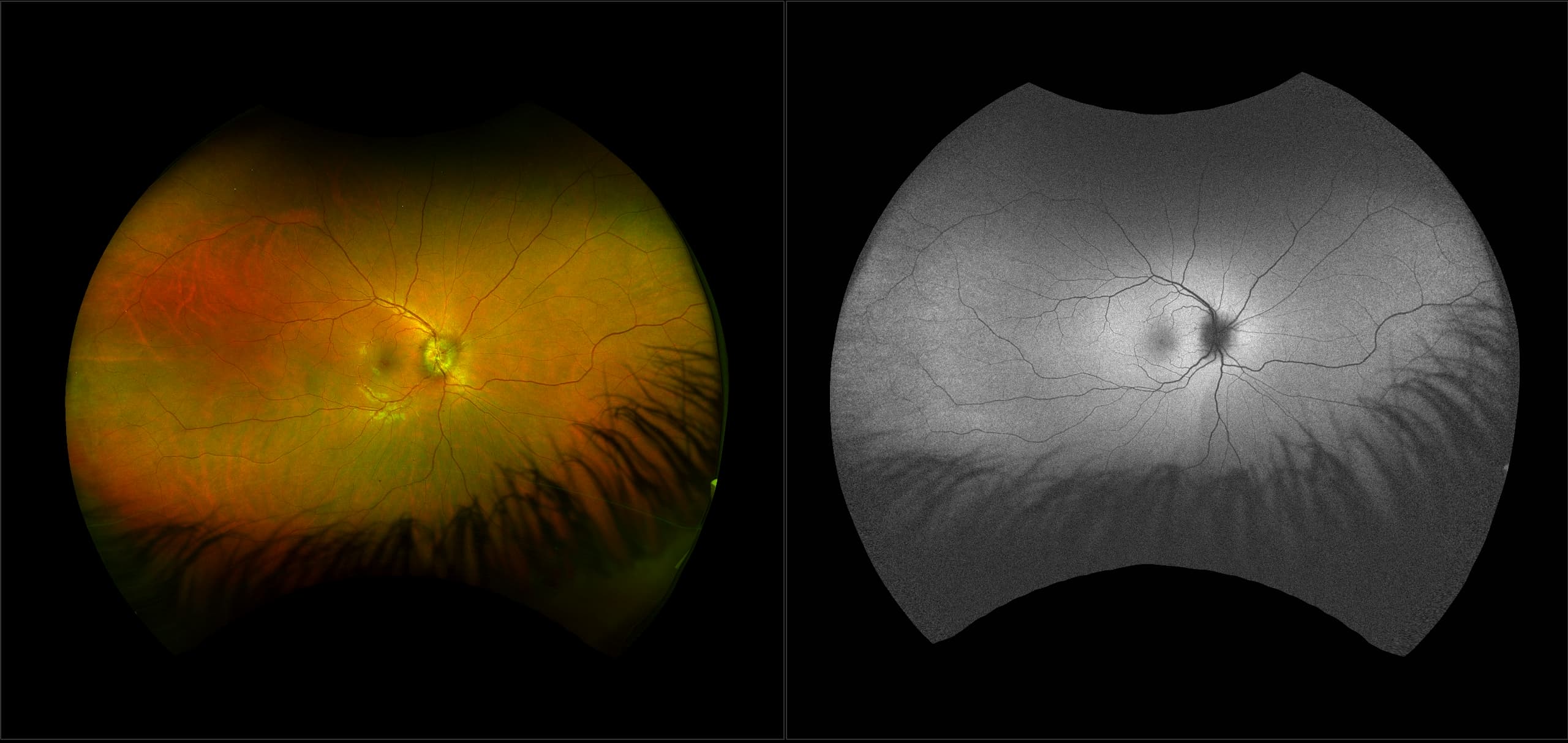 California - Papilledema, RG, AF