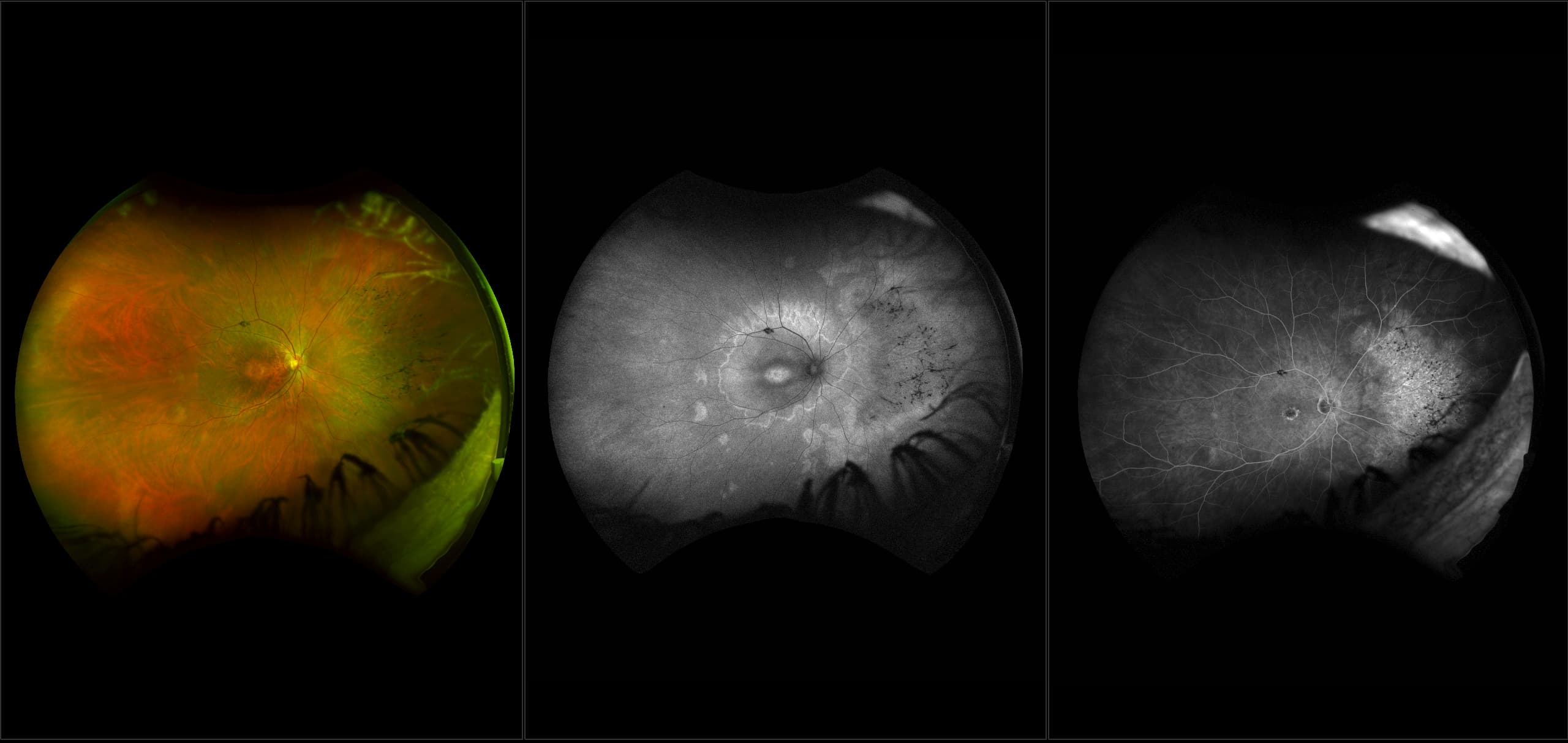 California - Retinitis Pigmentosa, RG, AF, FA