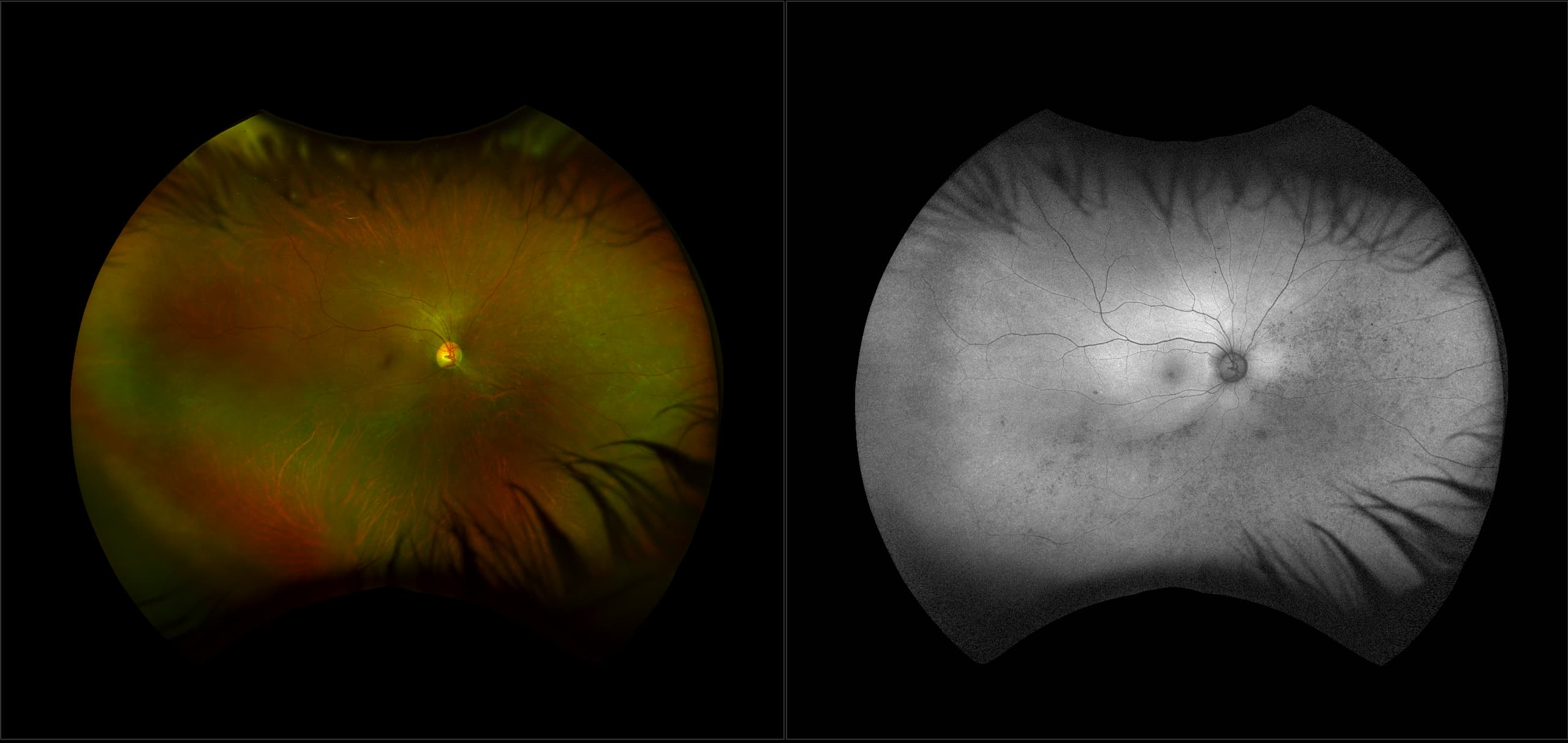 California - Retinal Degeneration, RG, AF