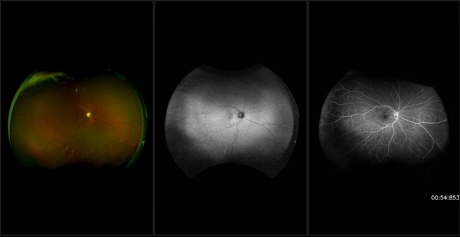 California - Hemi Retinal Vein Occlusion, RG, AF, FA