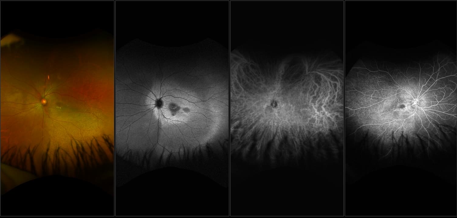 California - Macular Dystrophy, RG, AF, FA, ICG