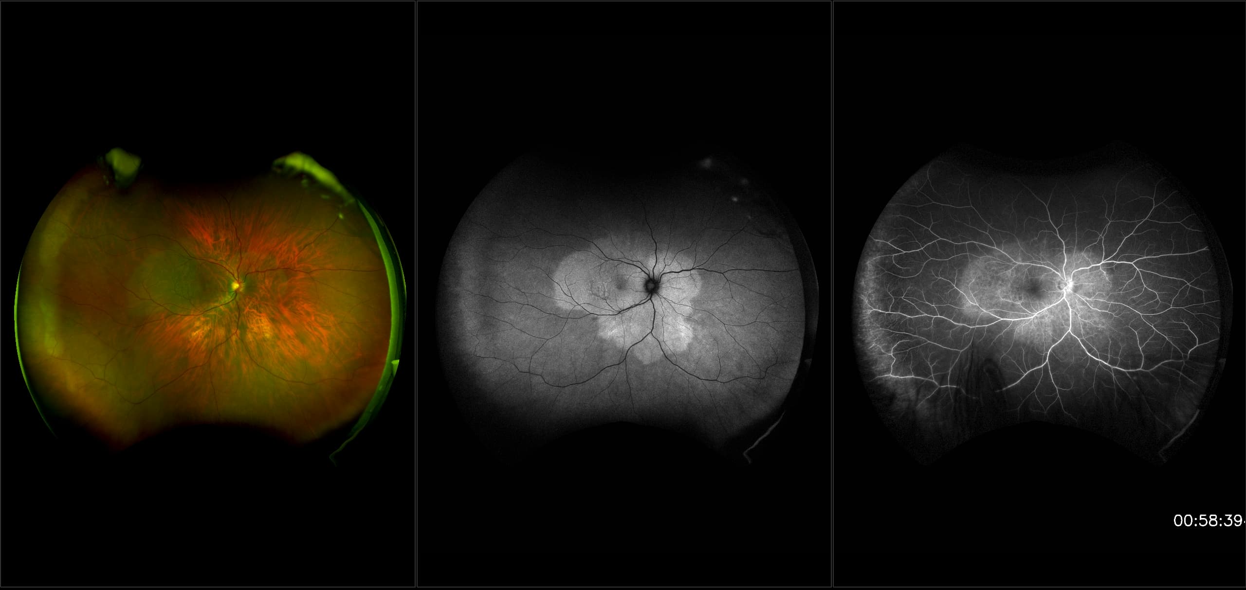 California - Uveitis, RG, AF, FA