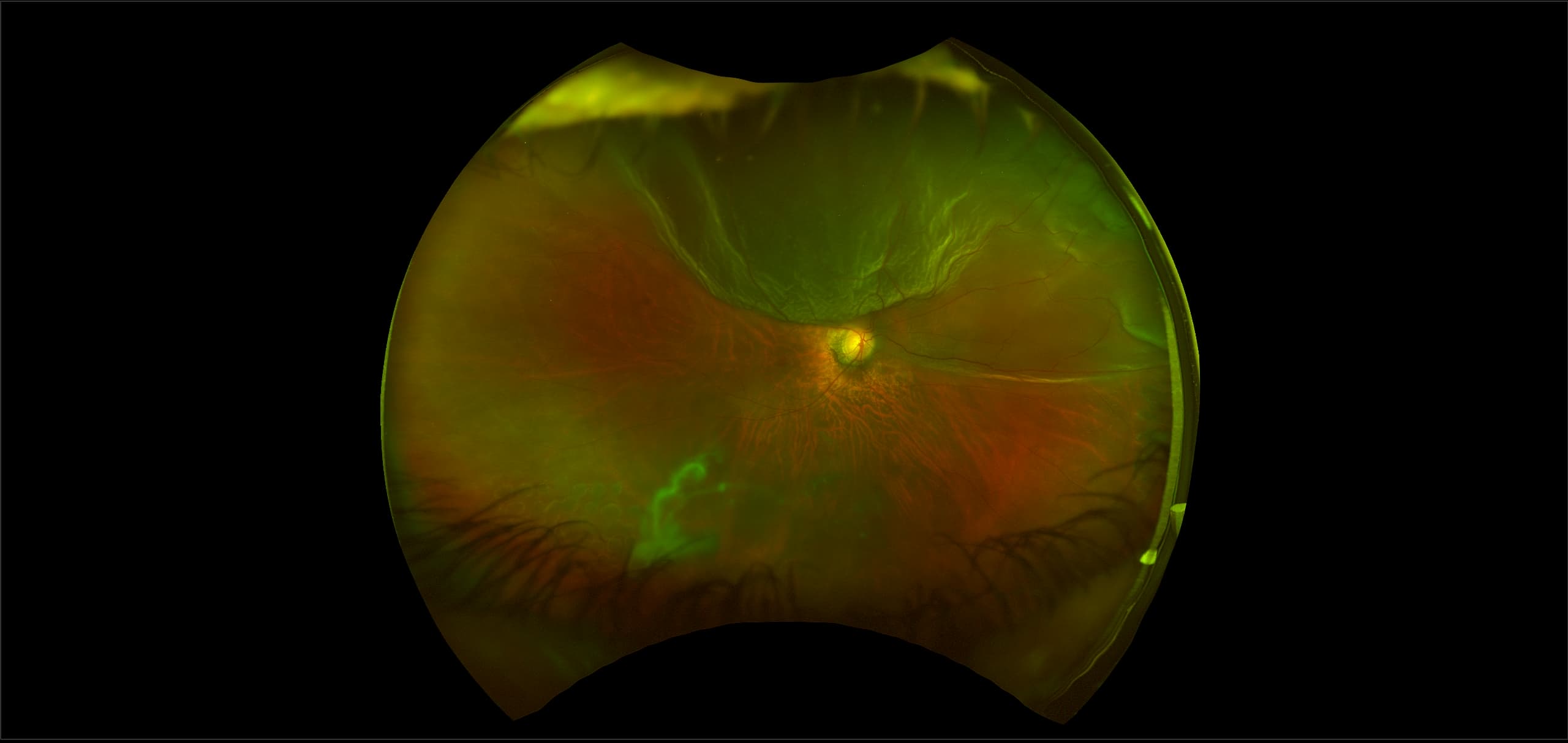 California - Retinal Detachment, RG