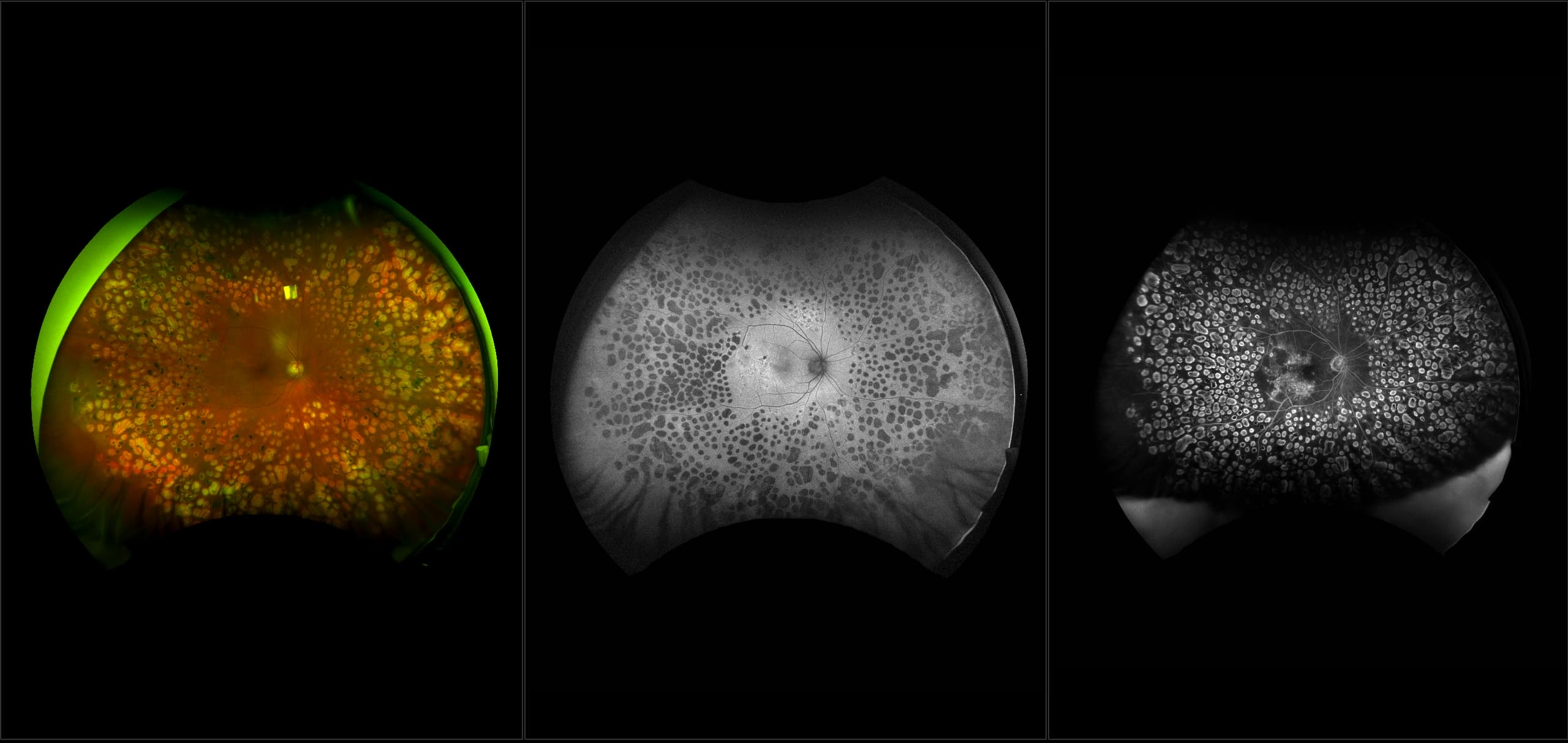 California - Proliferative Diabetic Retinopathy, RG, AF, FA