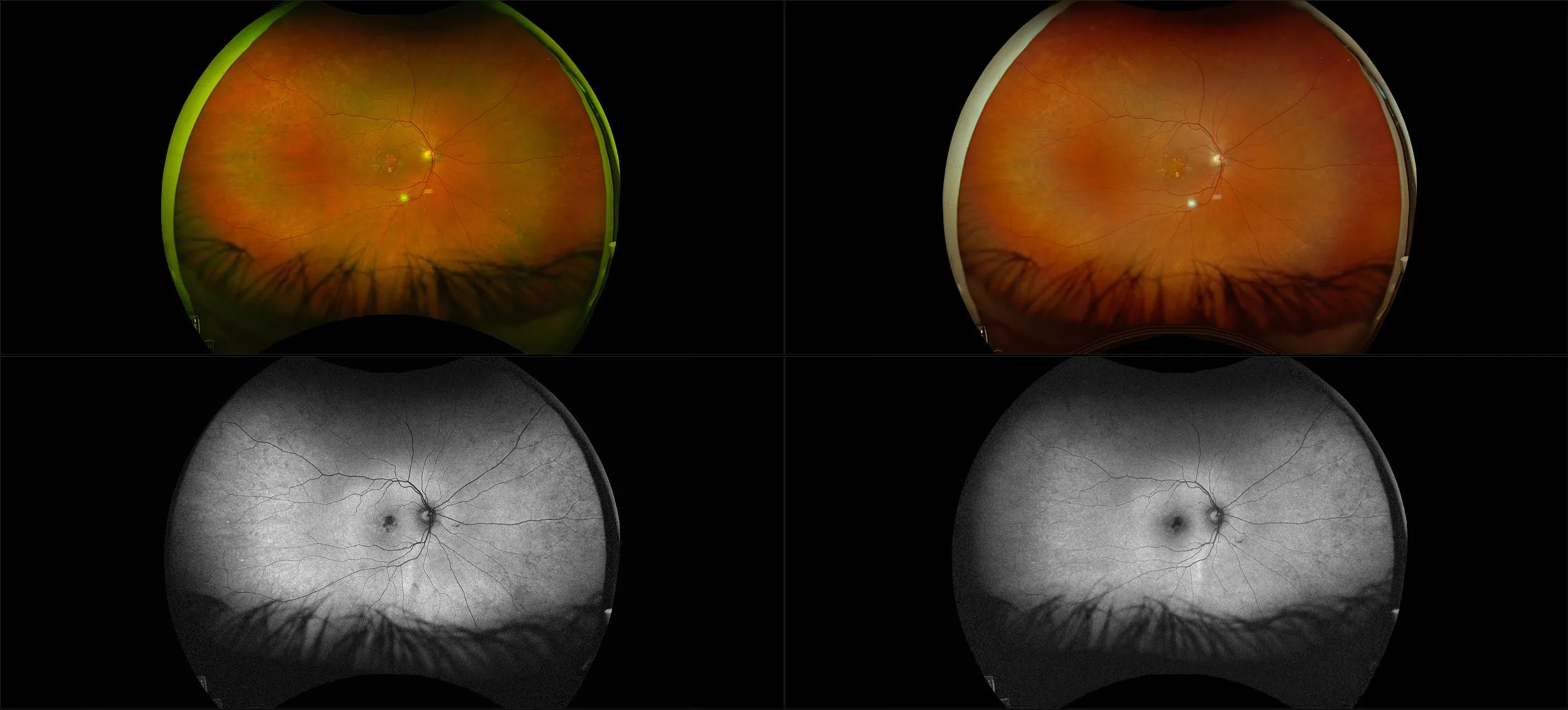California - Nonexudative Age-Related Macular Degeneration with Geographic Atrophy, RG, RBG, AF, BAF