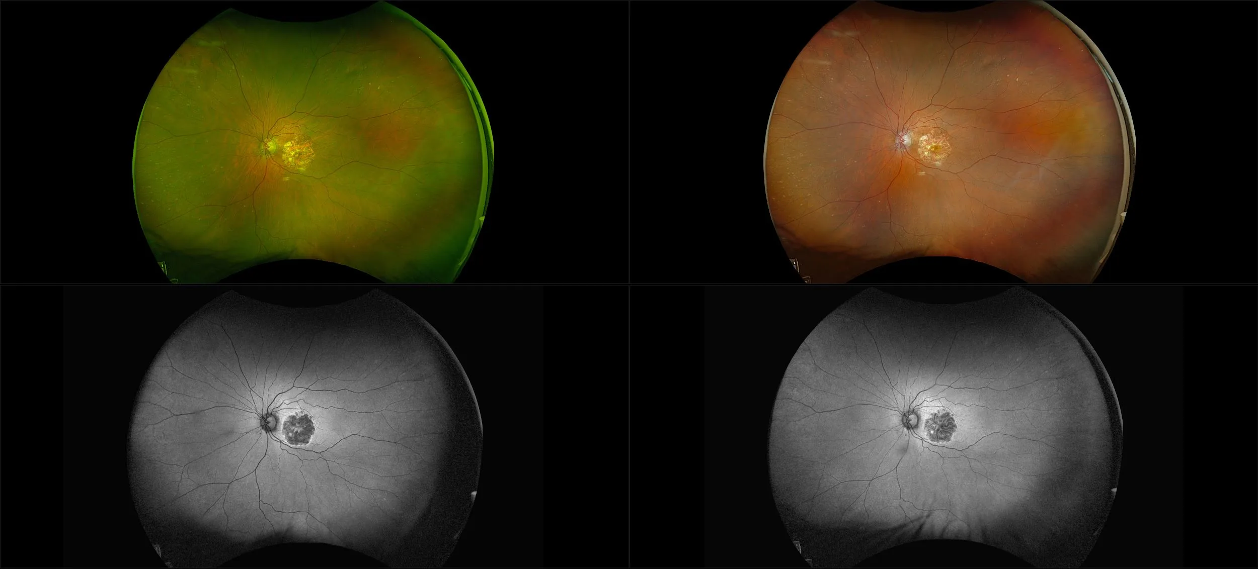 California - Nonexudative Age-Related Macular Degeneration with Geographic Atrophy, RG, RGB, AF, BAF