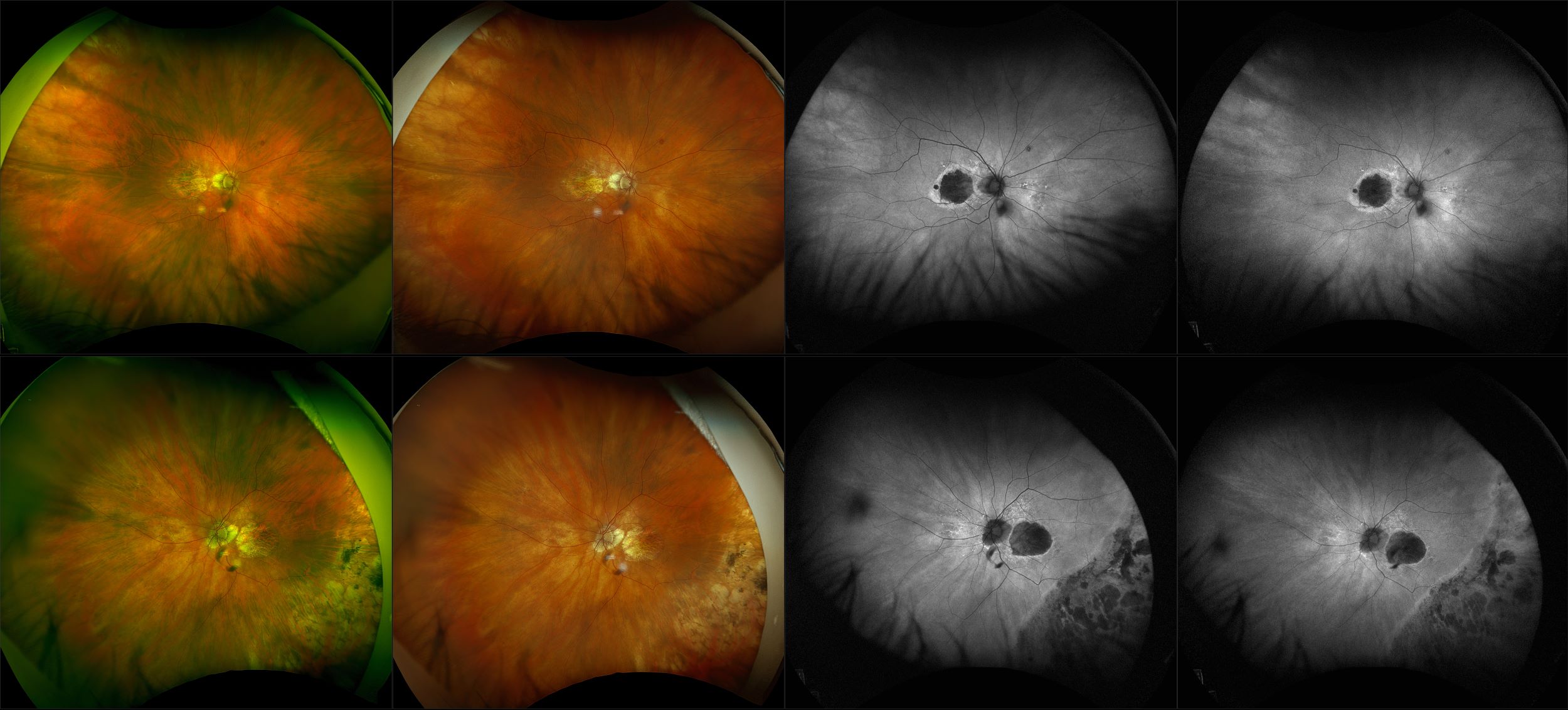 California - Geographic Atrophy, RG, RGB, AF, BAF