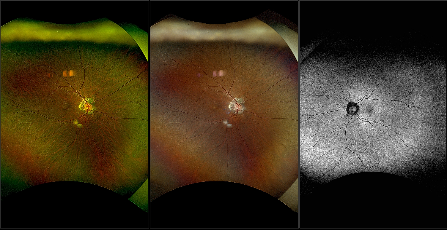 California - Irvine Gass Syndrome and Epiretinal Membrane, RG, AF, RGB