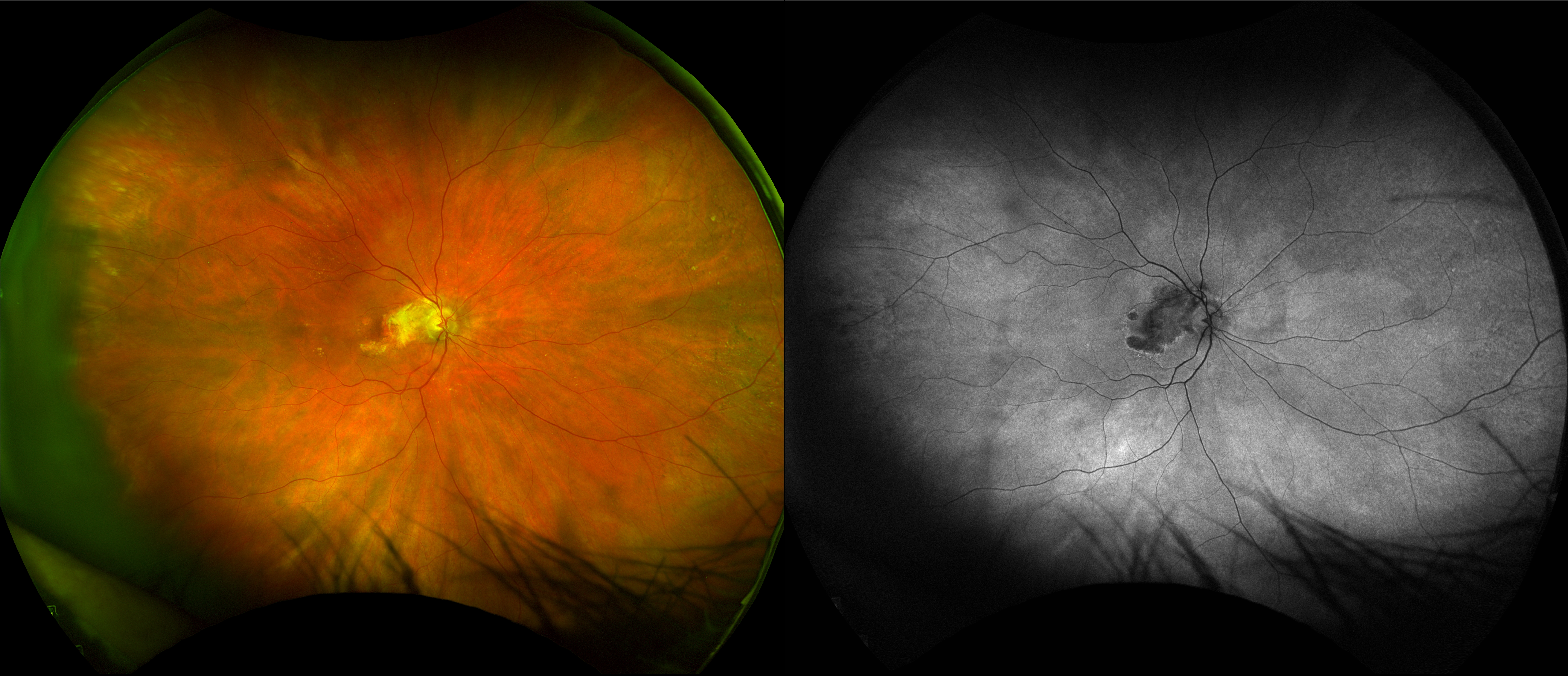 California - Osteoma with AMD and CNV, RG, AF