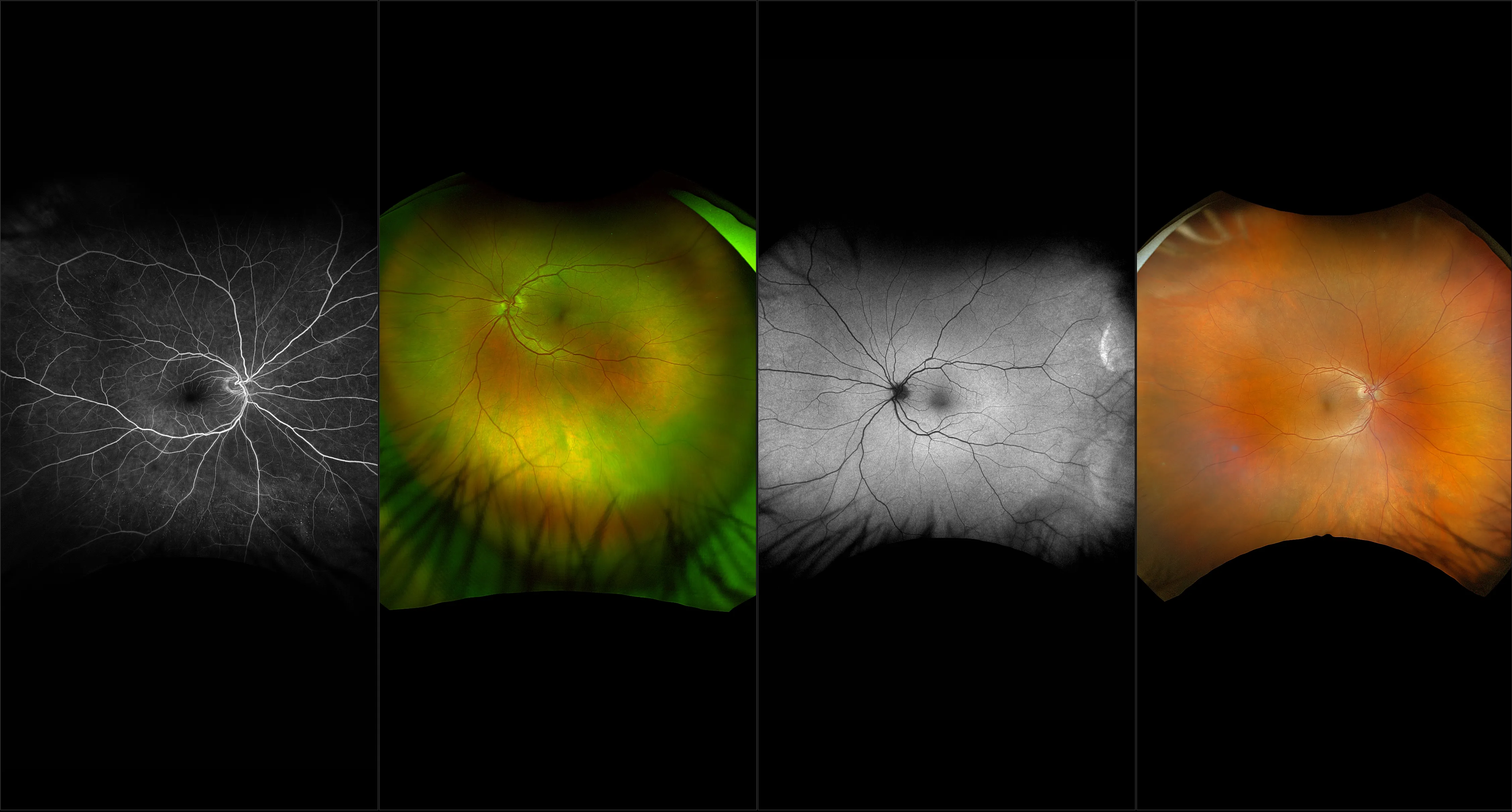 California - Retinoschisis, RG, RGB, AF, FA