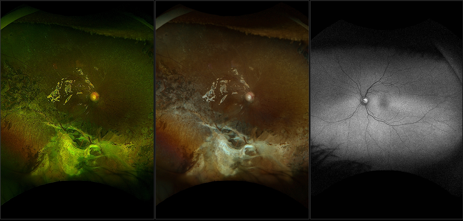 California - Acute Retinal Necrosis with Repaired RD, PVR, CME and Silicone Oil, RG RGB, AF