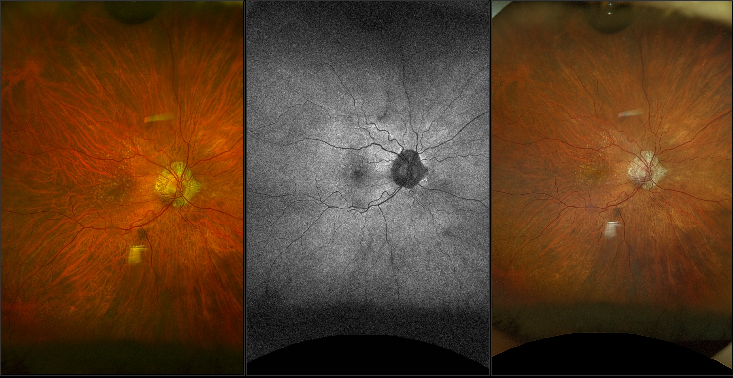 California - AMD with Geographic Atrophy, RG, AF, RGB