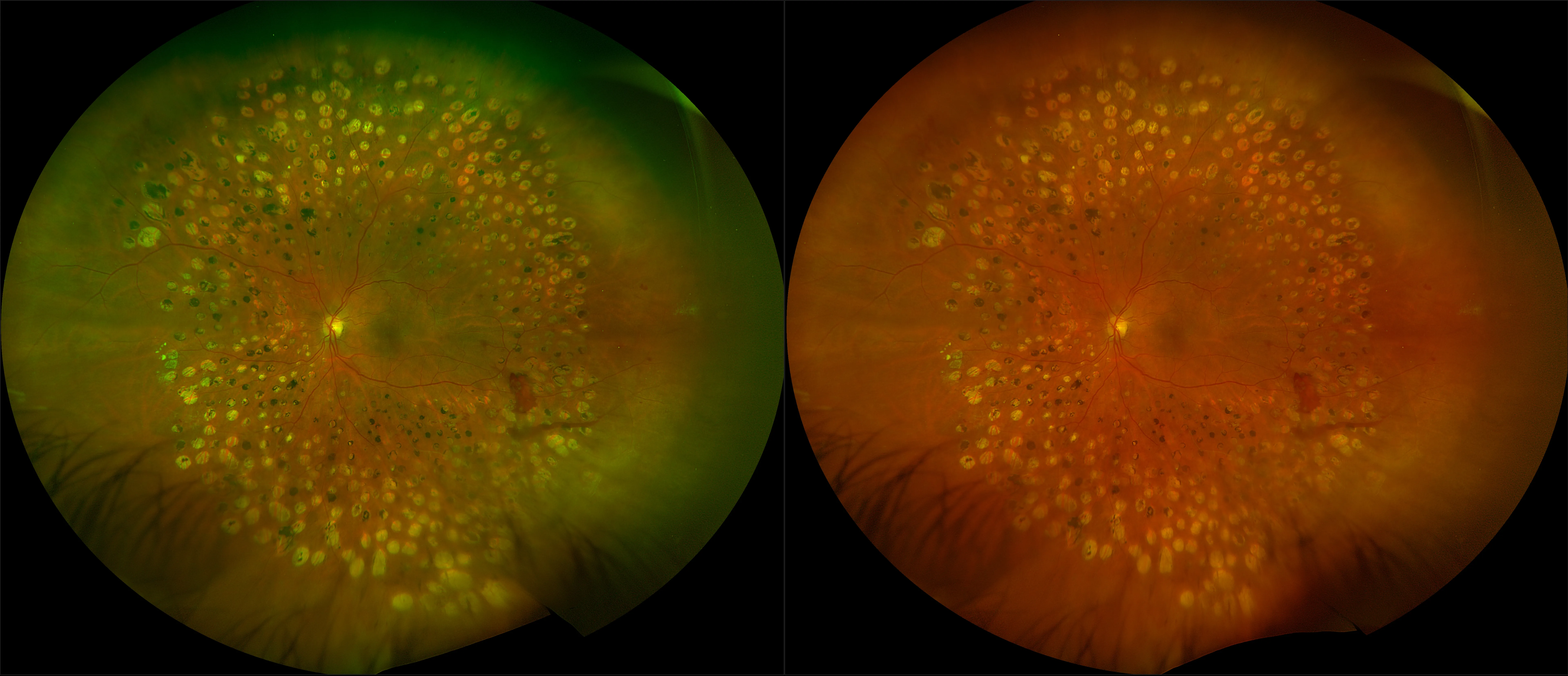 California - Proliferative Diabetic Retinopathy with PRP, RG, RGB